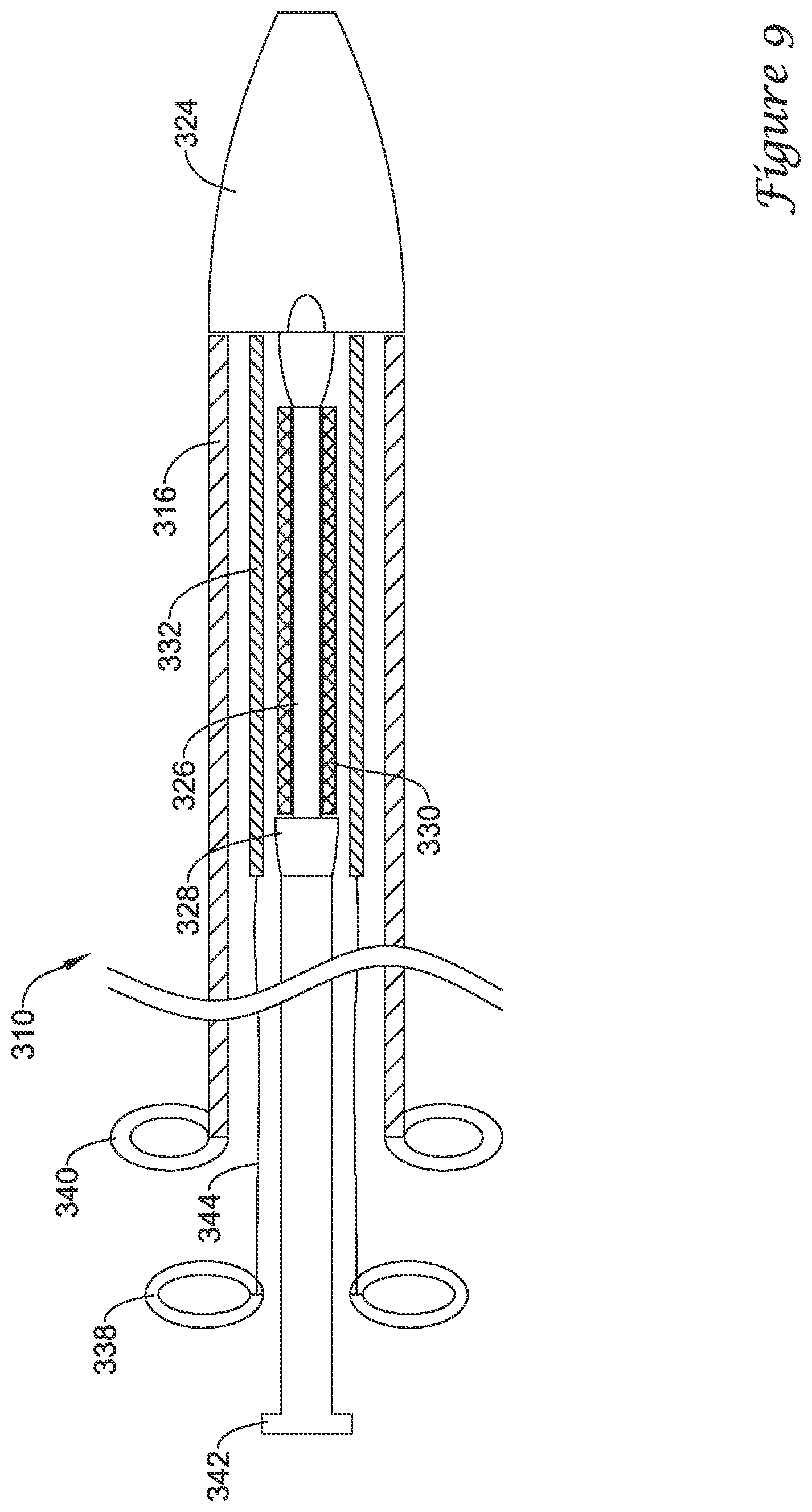 Patent US12376980 Figure 9 – Stent delivery systems with a reconstraining member