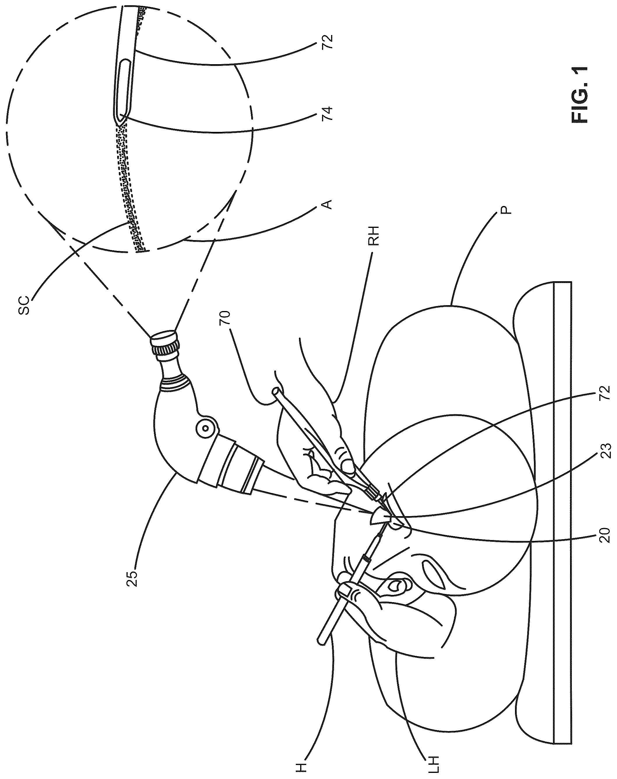 Patent US12376988 Figure 1 – Apparatus for delivering ocular implants into an anterior chamber of the eye