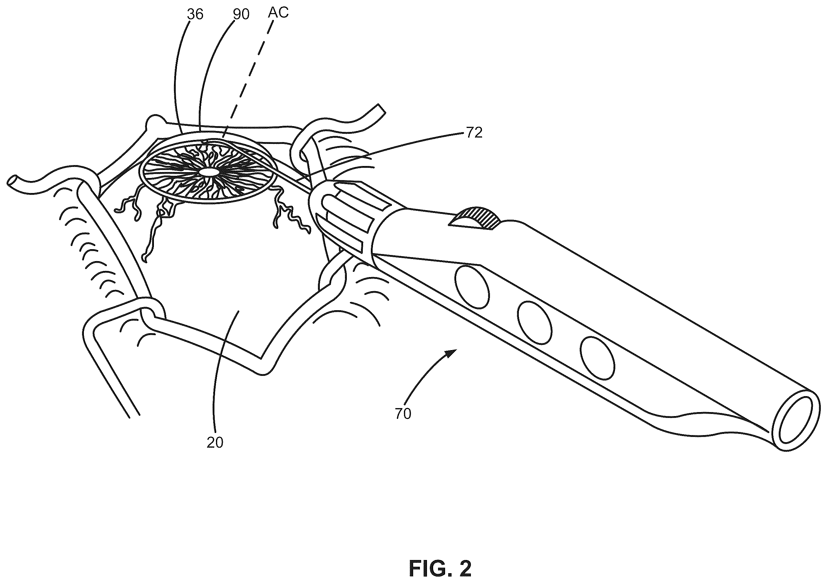 Patent US12376988 Figure 2 – Apparatus for delivering ocular implants into an anterior chamber of the eye