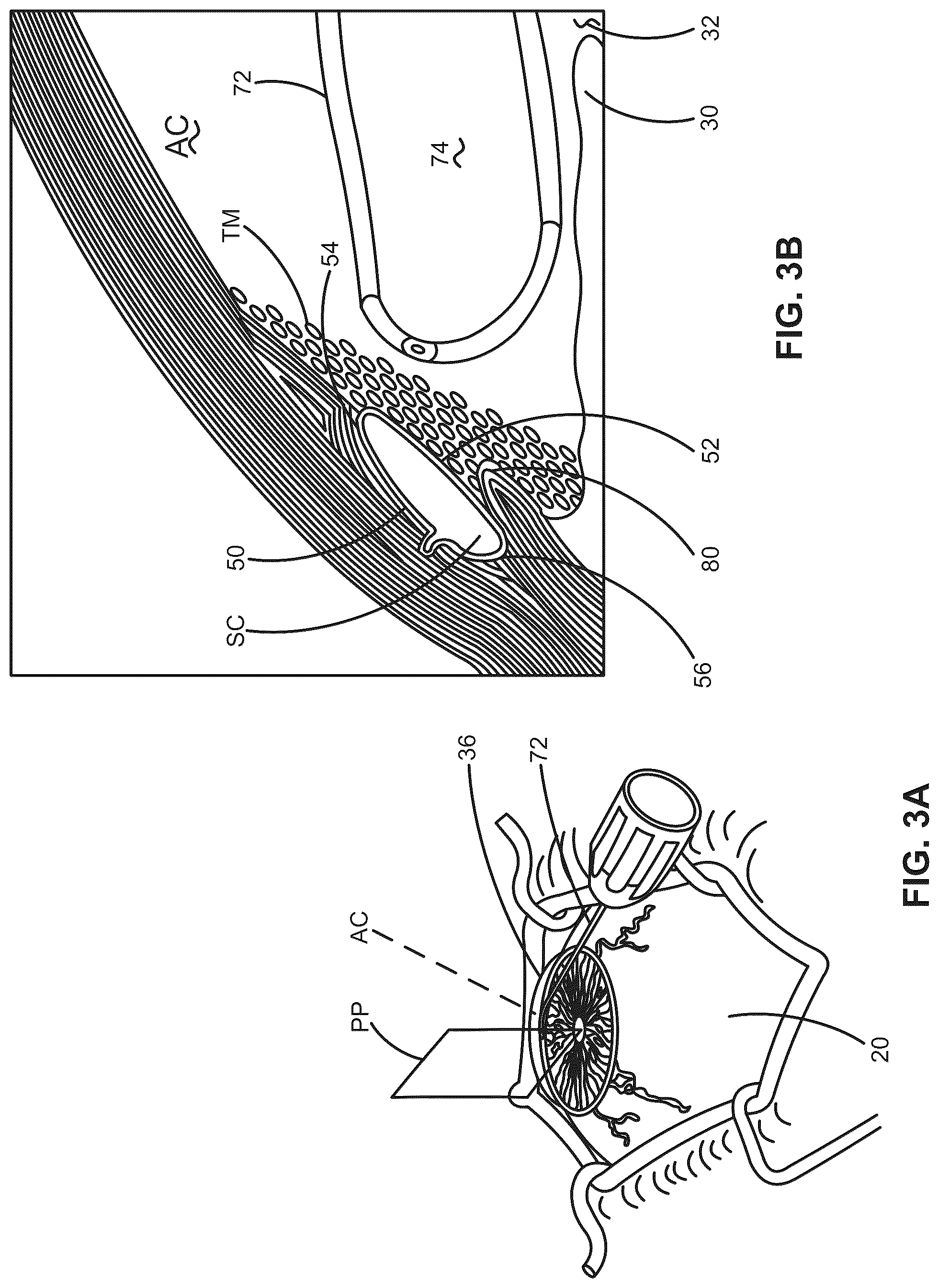 Patent US12376988 Figure 3 – Apparatus for delivering ocular implants into an anterior chamber of the eye