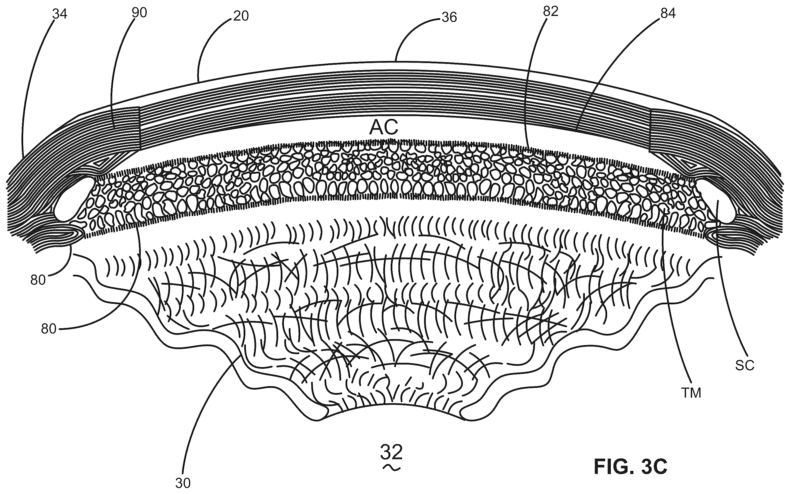 Patent US12376988 Figure 4 – Apparatus for delivering ocular implants into an anterior chamber of the eye