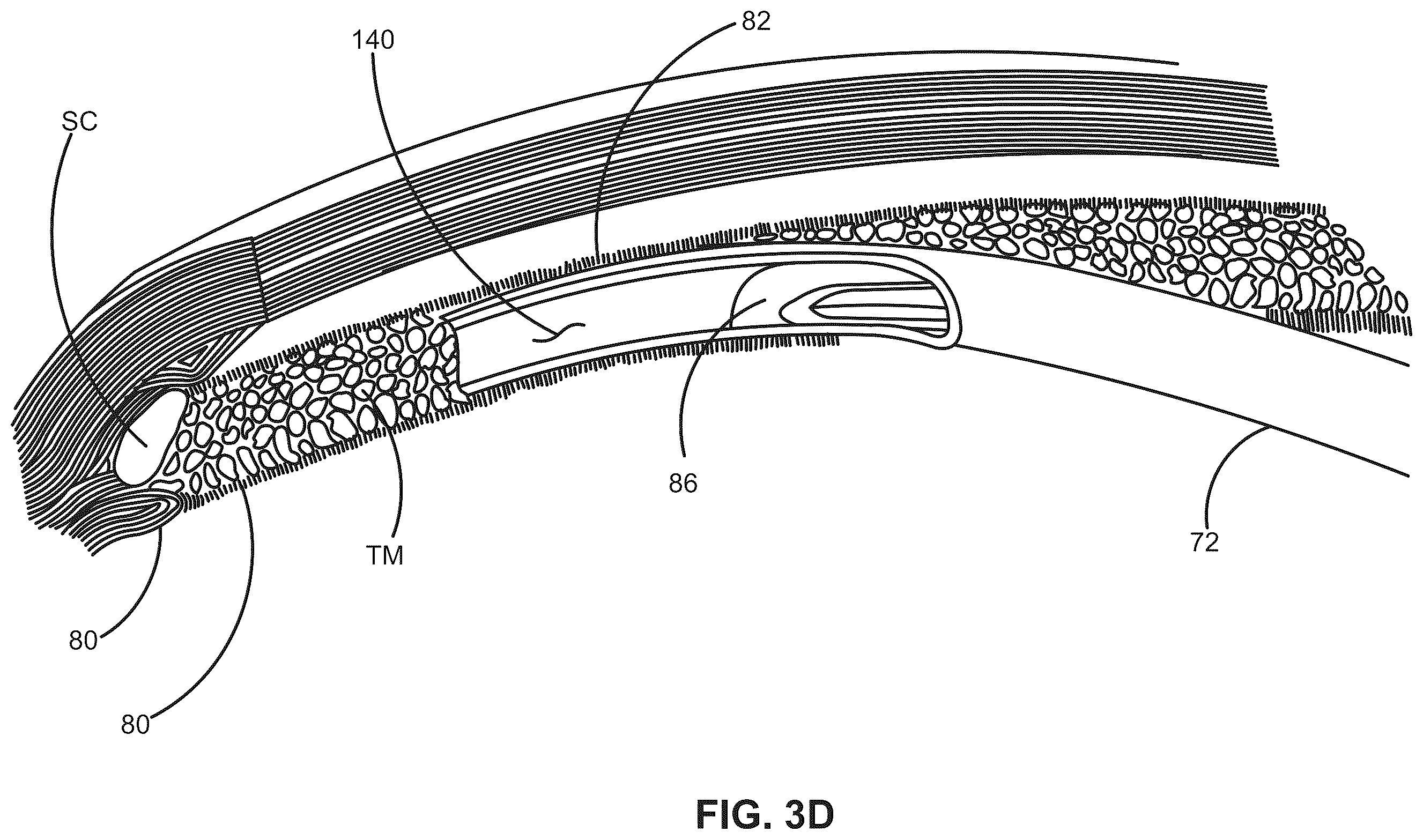 Patent US12376988 Figure 5 – Apparatus for delivering ocular implants into an anterior chamber of the eye