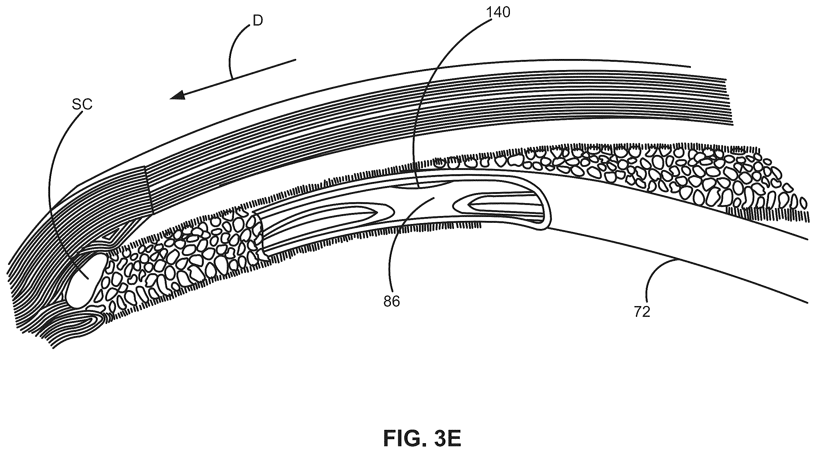 Patent US12376988 Figure 6 – Apparatus for delivering ocular implants into an anterior chamber of the eye
