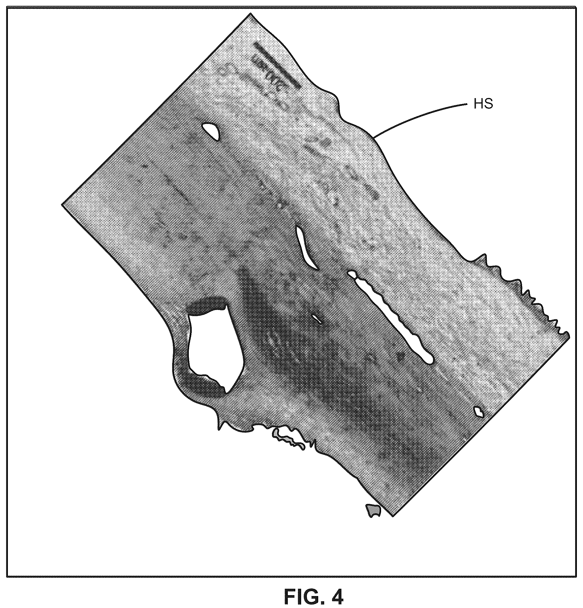 Patent US12376988 Figure 7 – Apparatus for delivering ocular implants into an anterior chamber of the eye