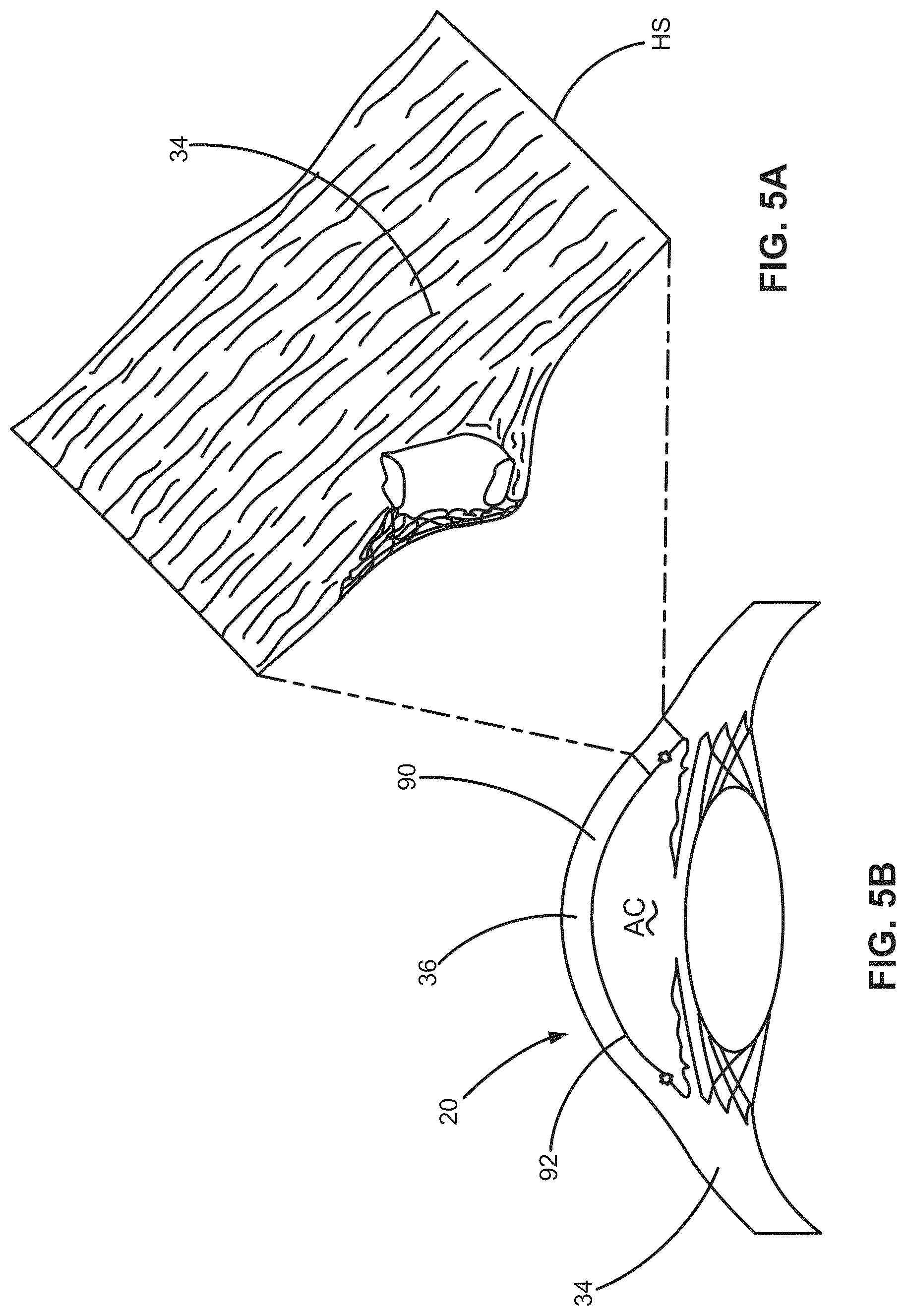 Patent US12376988 Figure 8 – Apparatus for delivering ocular implants into an anterior chamber of the eye