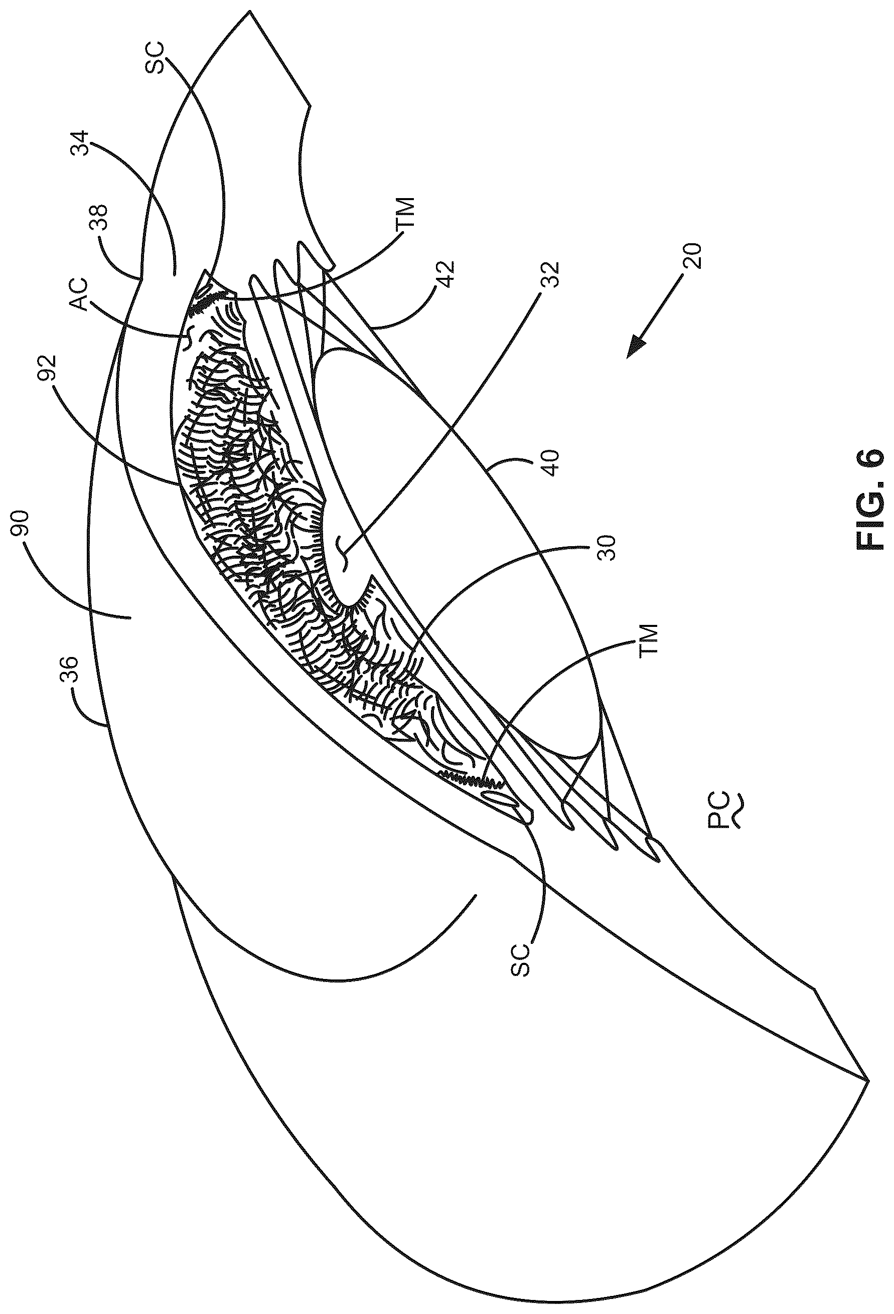 Patent US12376988 Figure 9 – Apparatus for delivering ocular implants into an anterior chamber of the eye