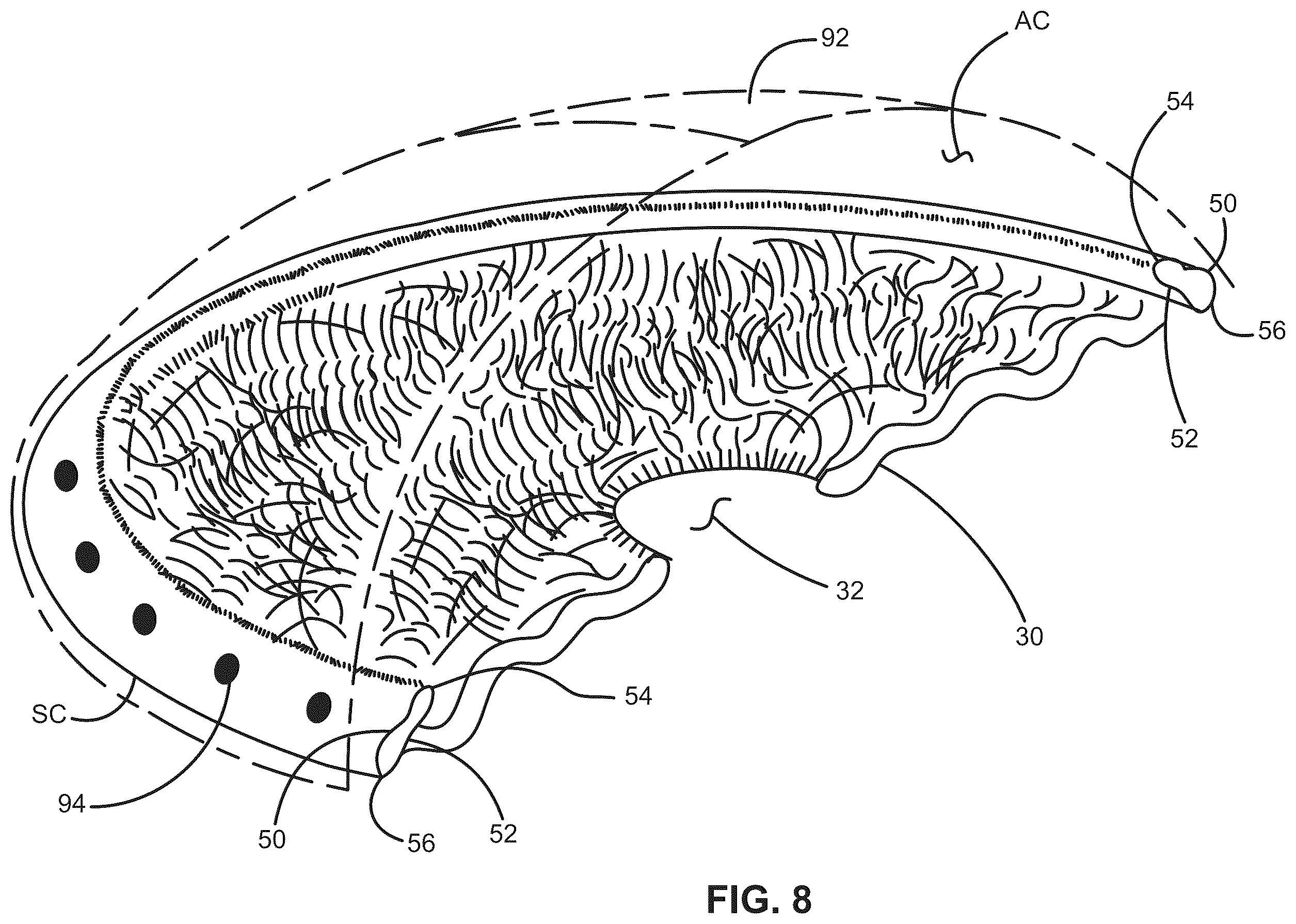 Patent US12376988 Figure 11 – Apparatus for delivering ocular implants into an anterior chamber of the eye