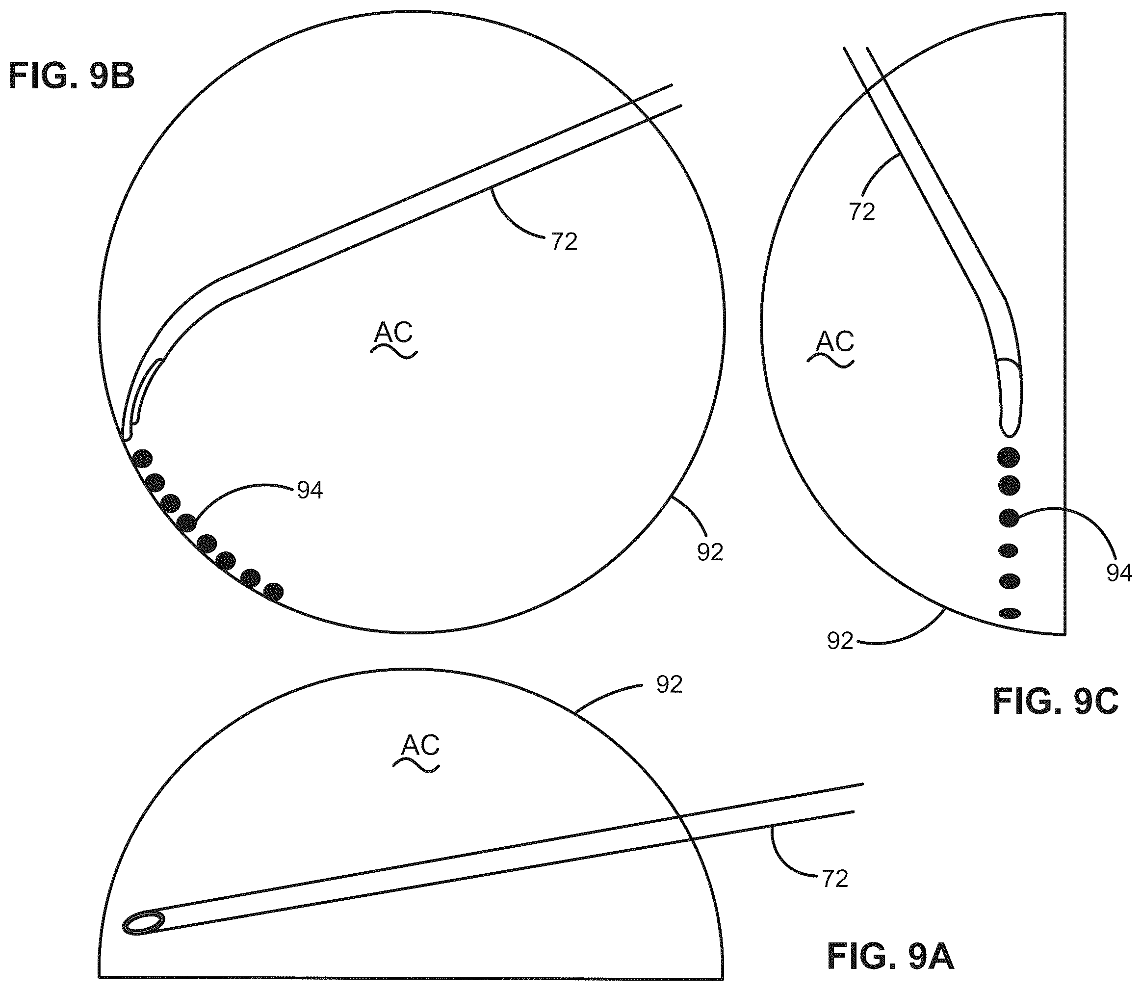Patent US12376988 Figure 12 – Apparatus for delivering ocular implants into an anterior chamber of the eye
