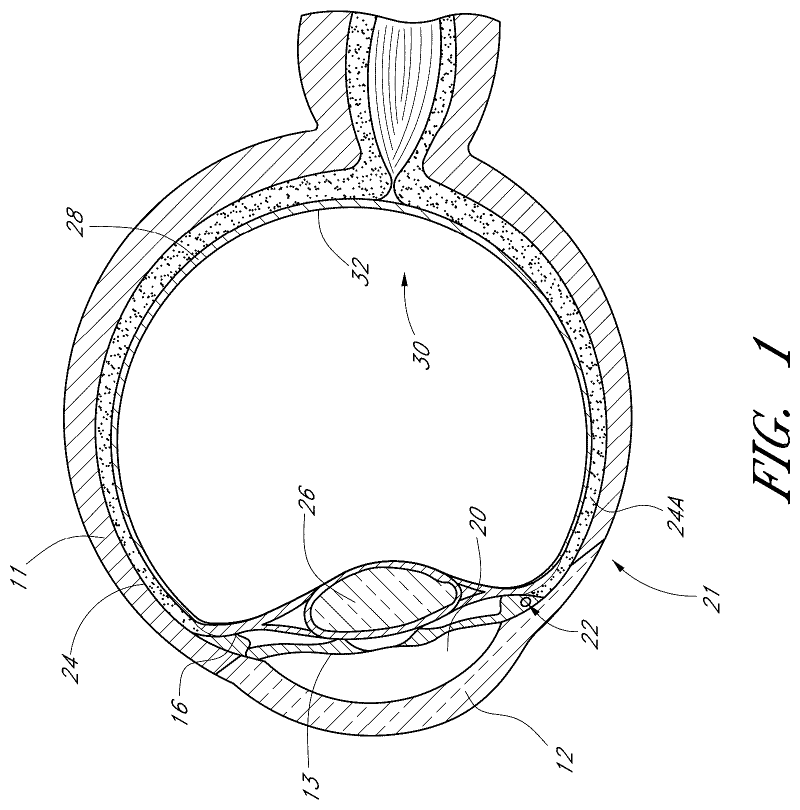 Patent US12376989 Figure 1 – Drug eluting ocular implants and methods of treating an ocular disorder