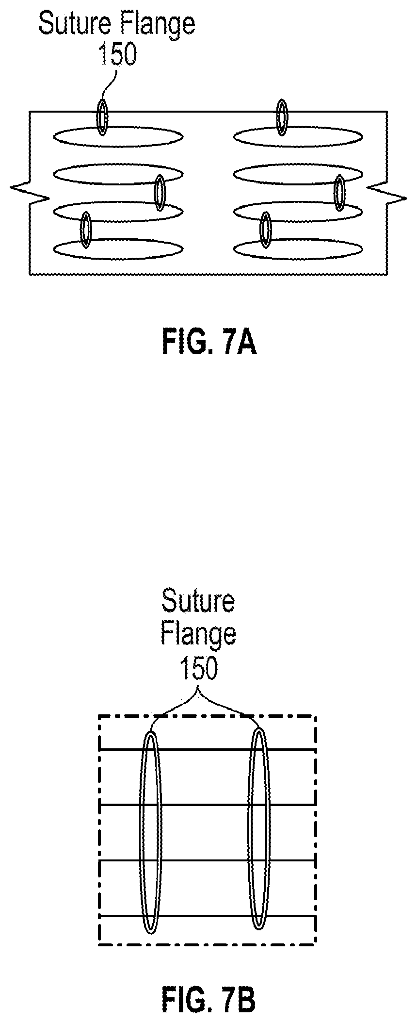 Patent US12376991 Figure 8 – Scleral buckle for alleviation of retinal detachment and refractive error