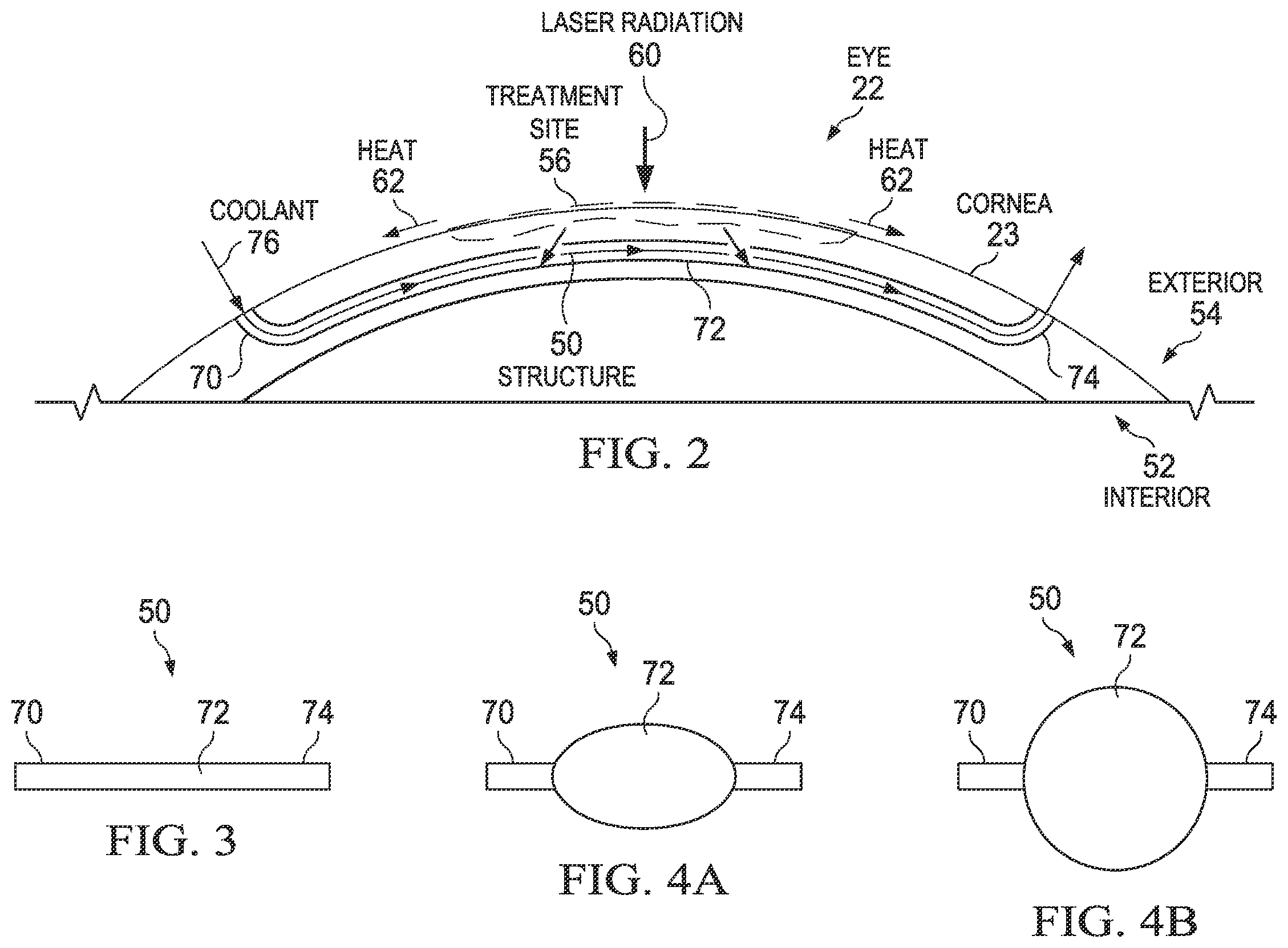 Patent US12376993 Figure 2 – Controlling the temperature of the cornea during ophthalmic surgery