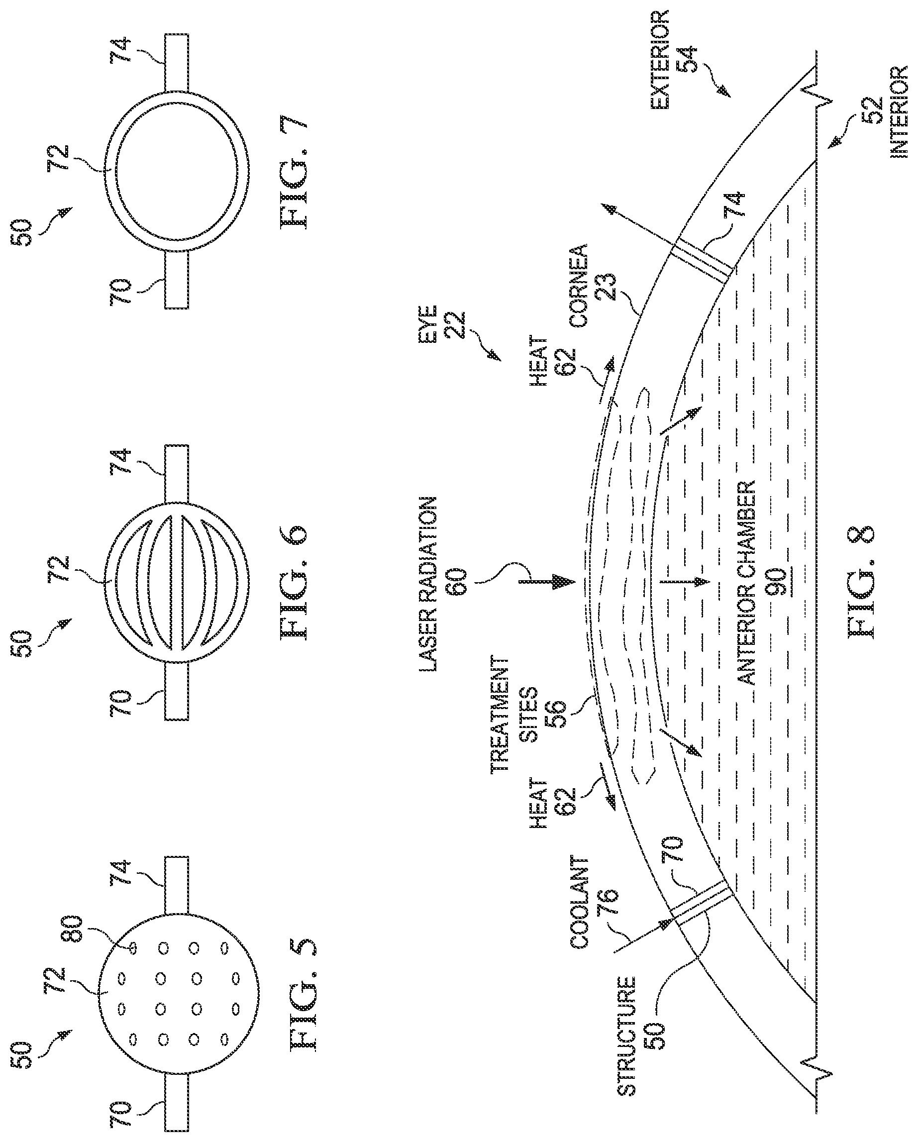Patent US12376993 Figure 3 – Controlling the temperature of the cornea during ophthalmic surgery