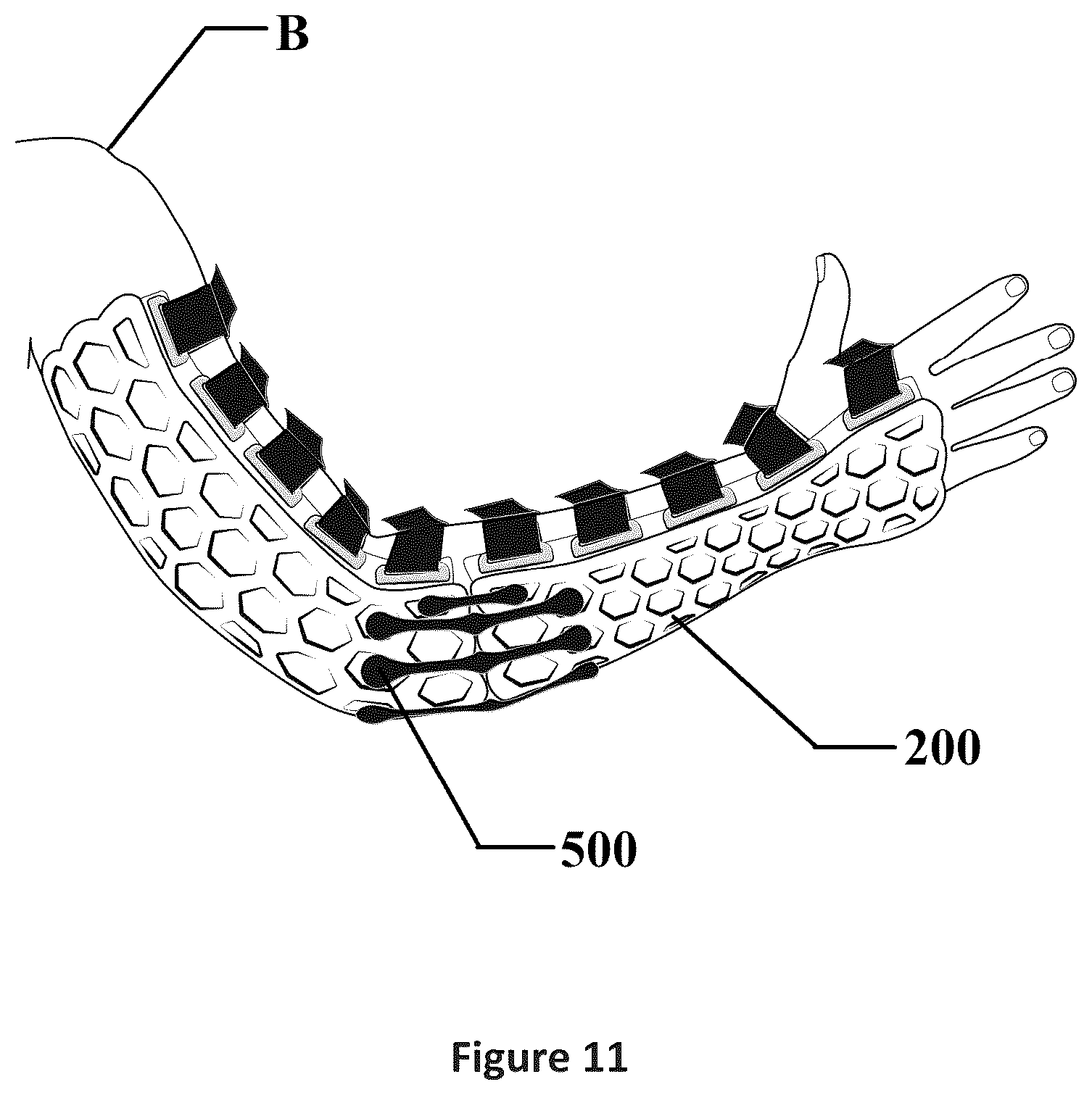 Patent US12376997 Figure 12 – Adjustable limb stabilization device