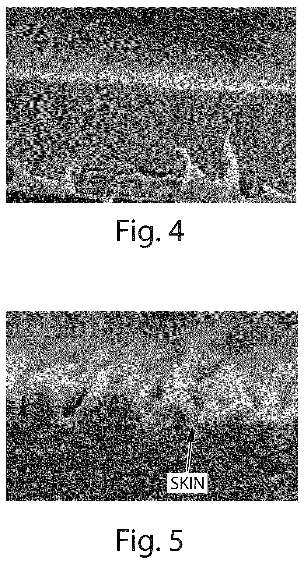 Patent US12377000 Figure 3 – Absorbent articles comprising stretch laminates