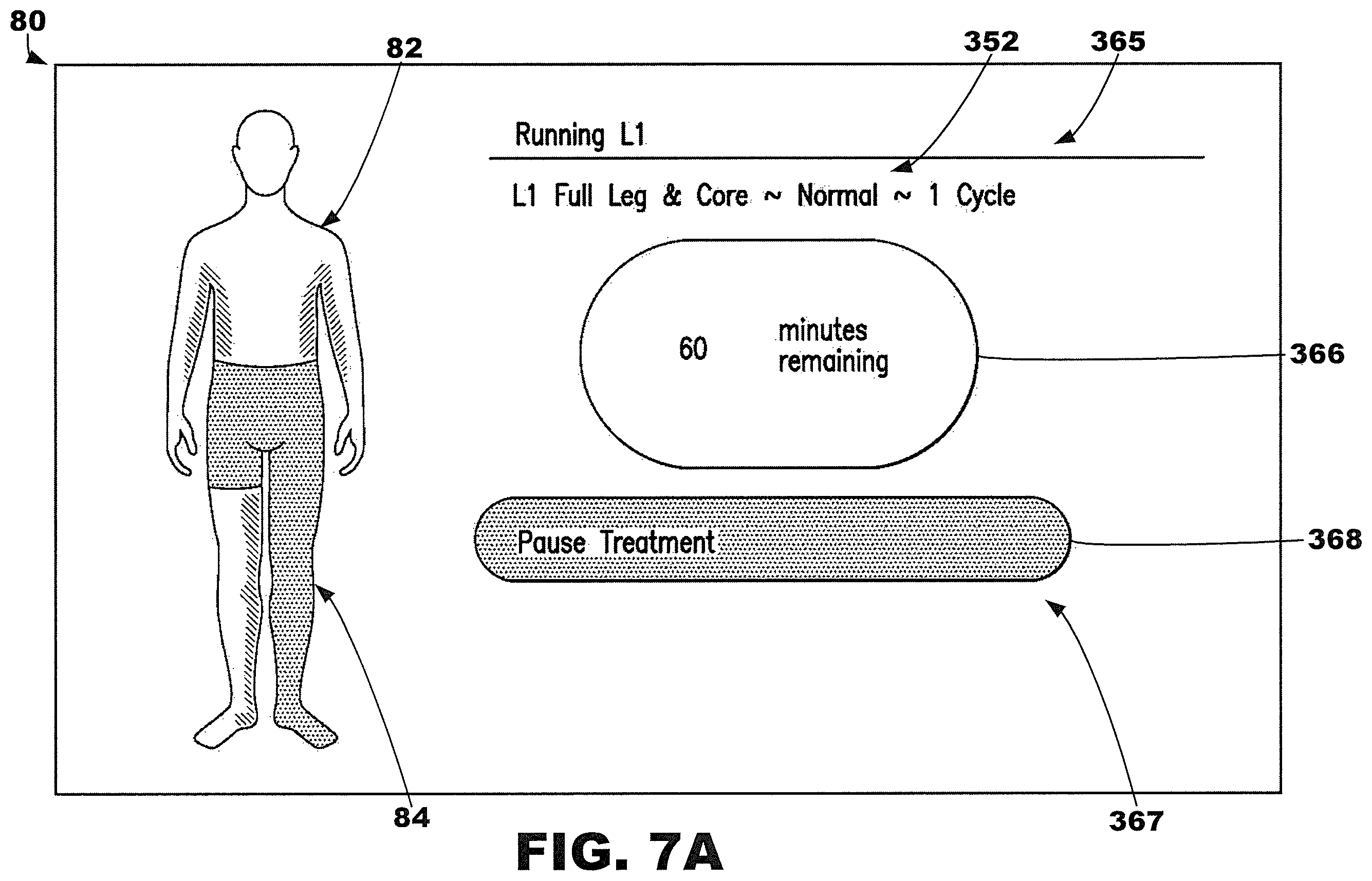 Patent US12377013 Figure 9 – Compression garment systems