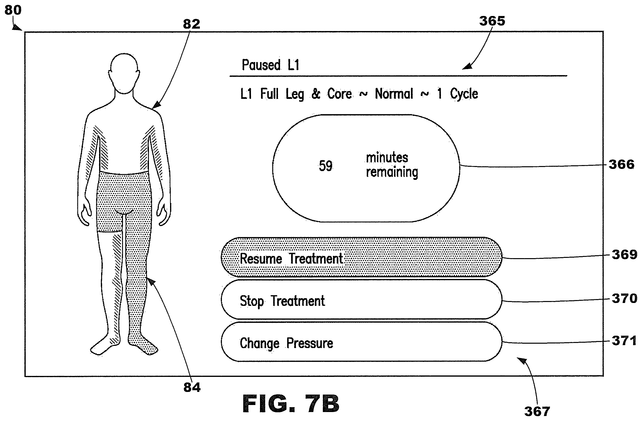 Patent US12377013 Figure 10 – Compression garment systems