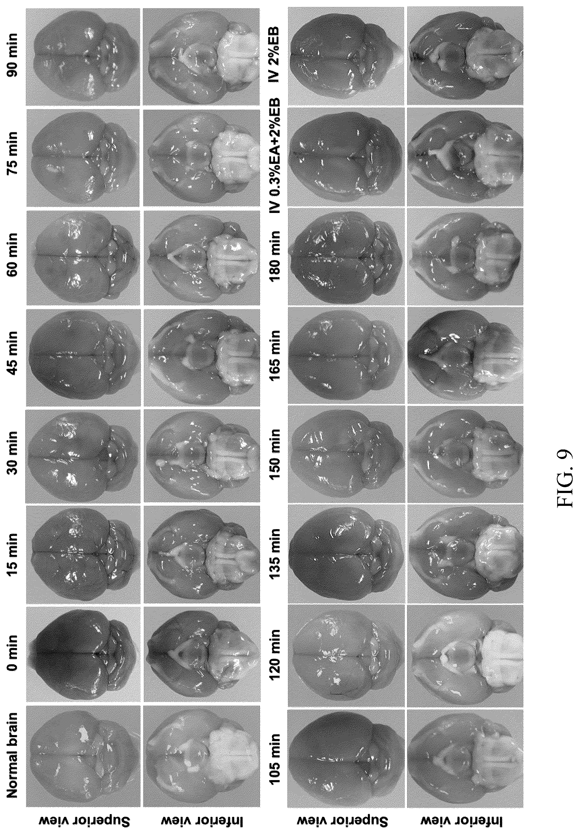 Patent US12377057 Figure 6 – Arterial application of low dose ethyl alcohol enables blood-brain barrier (BBB) transient opening