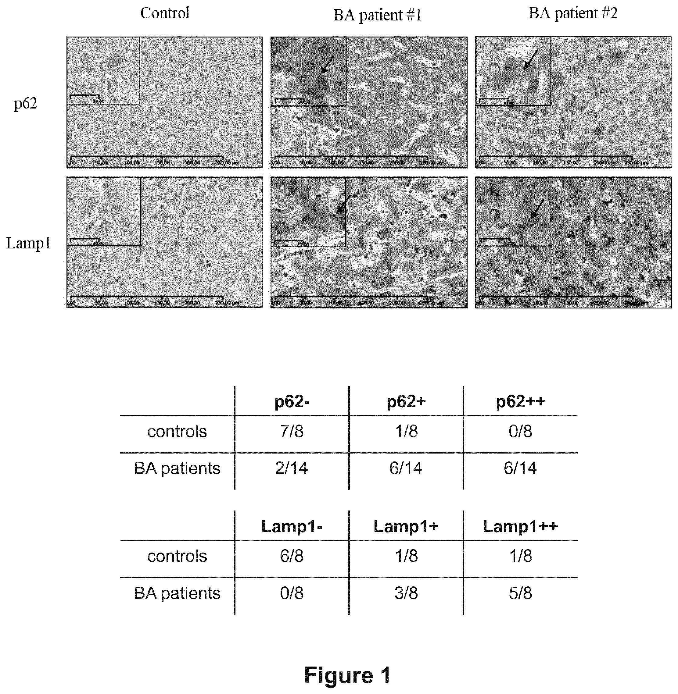 Patent US12377066 Figure 1 – Treatment of diseases associated with biliary system destruction