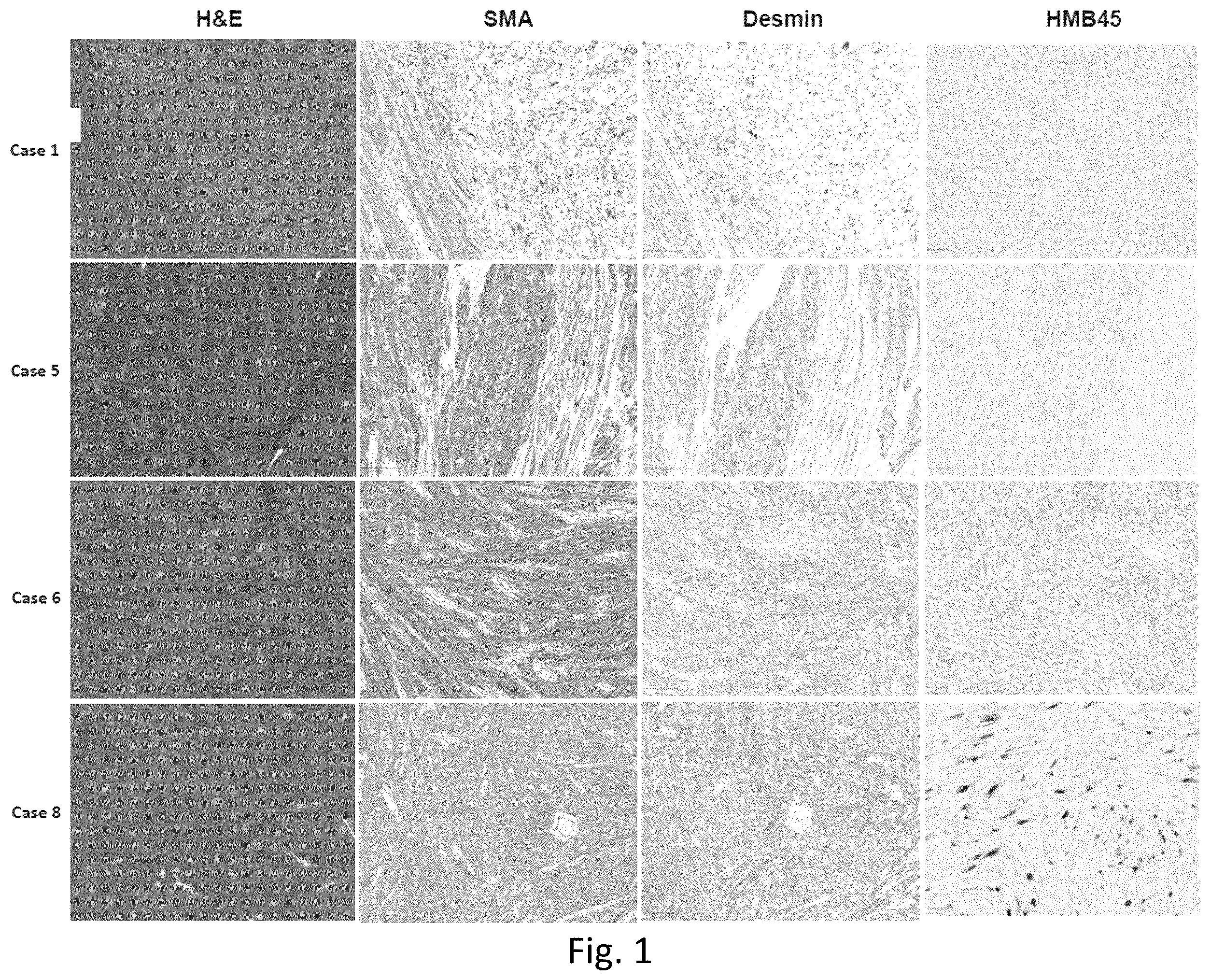 Patent US12377103 Figure 1 – Use of bromodomain-containing protein 9 inhibitors to treat and/or prevent uterine leiomyosarcoma