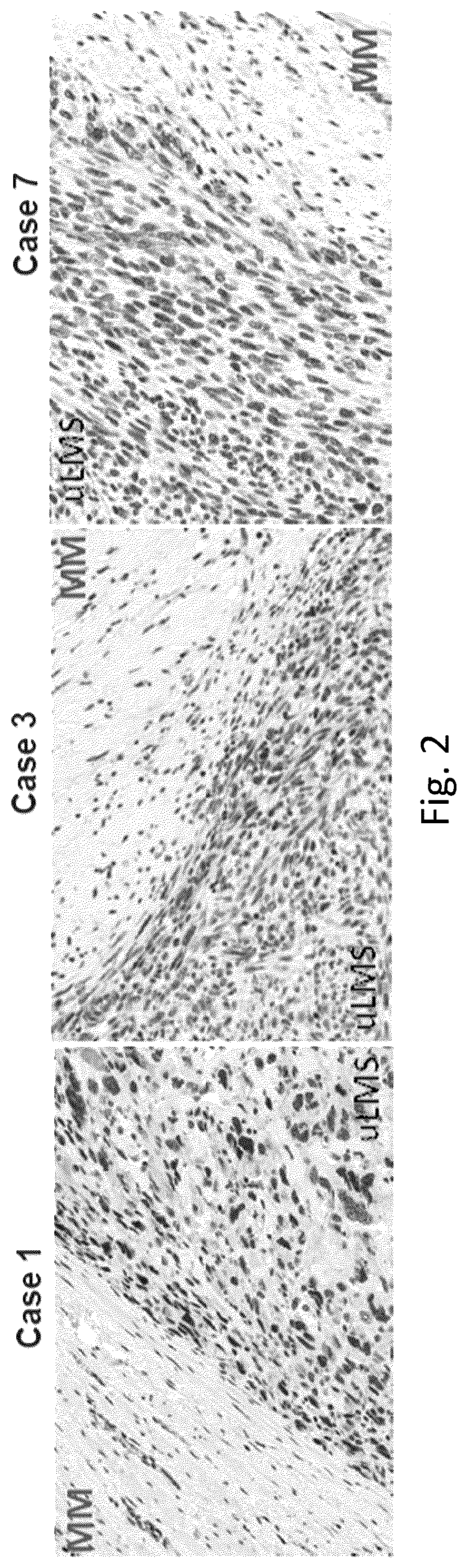 Patent US12377103 Figure 2 – Use of bromodomain-containing protein 9 inhibitors to treat and/or prevent uterine leiomyosarcoma