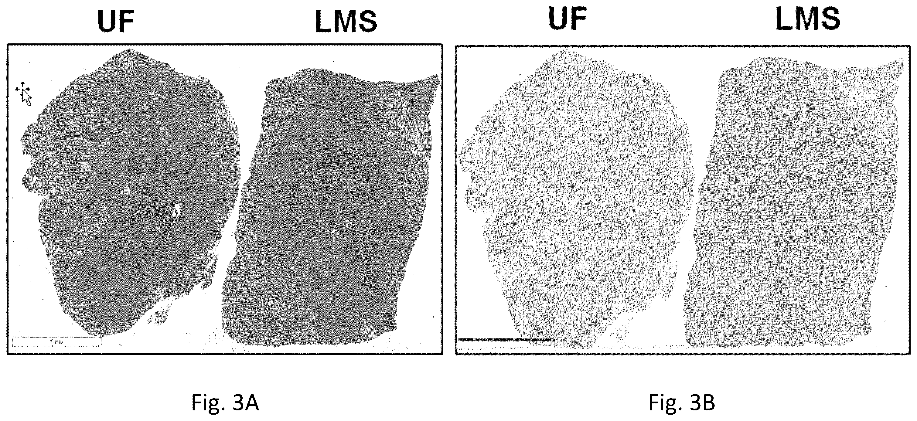 Patent US12377103 Figure 3 – Use of bromodomain-containing protein 9 inhibitors to treat and/or prevent uterine leiomyosarcoma