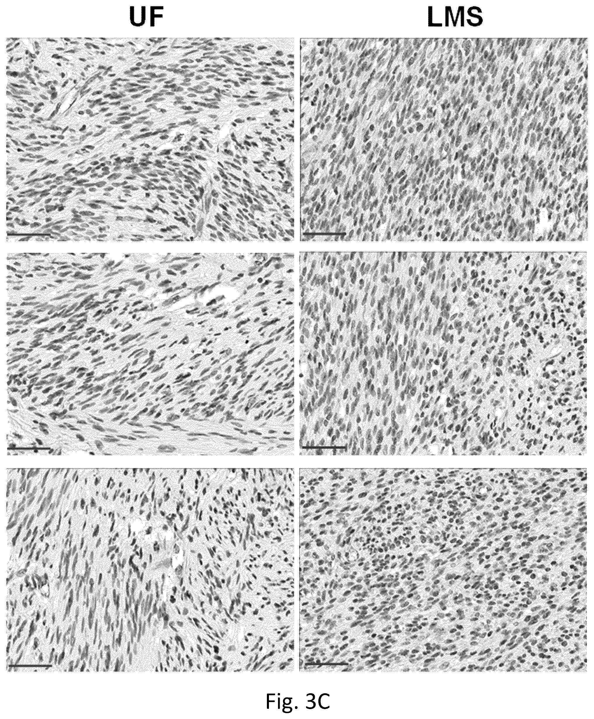 Patent US12377103 Figure 4 – Use of bromodomain-containing protein 9 inhibitors to treat and/or prevent uterine leiomyosarcoma