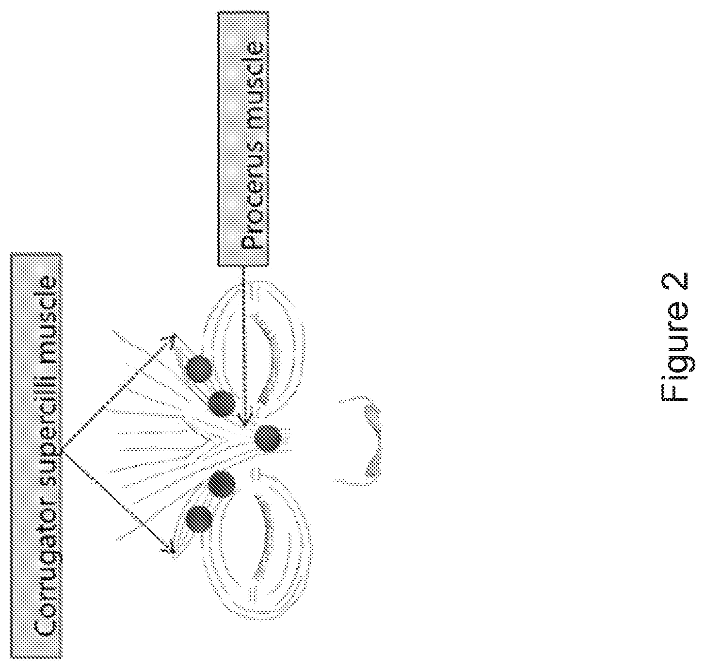 Patent US12377137 Figure 2 – Long lasting effect of new botulinum toxin formulations