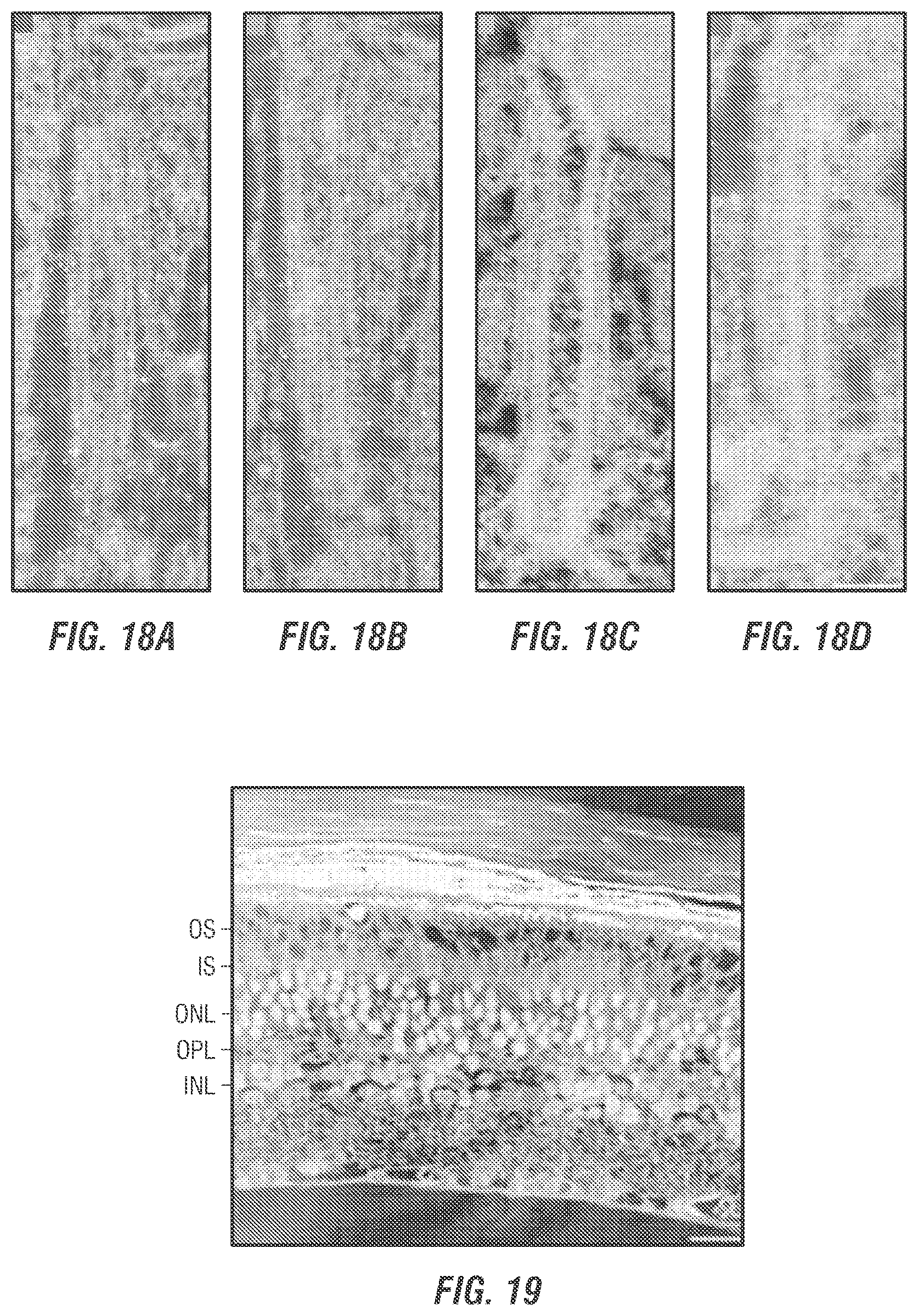 Patent US12377169 Figure 18 – Dual AAV-MYO7A vectors with improved safety for the treatment of USH1B