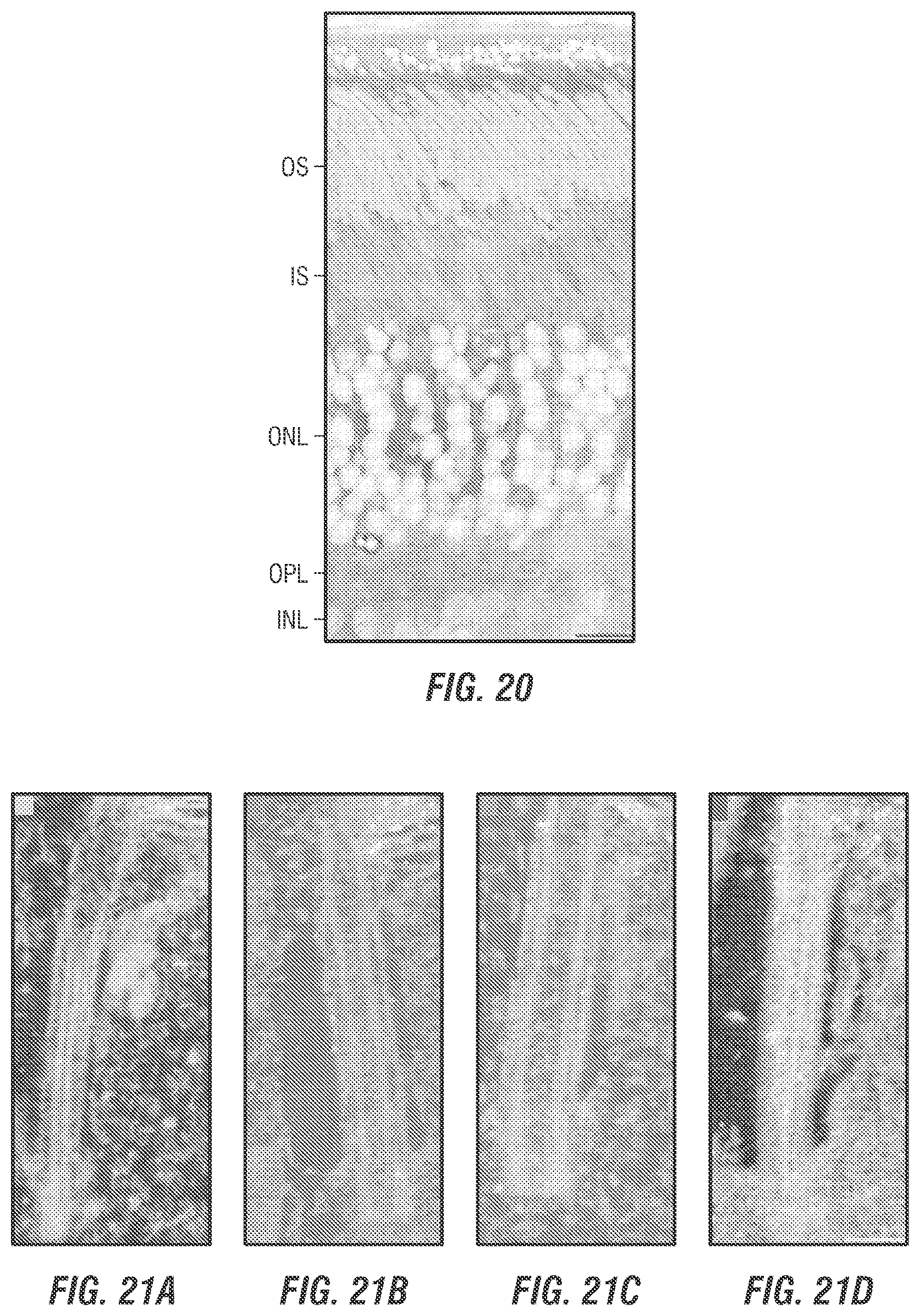 Patent US12377169 Figure 19 – Dual AAV-MYO7A vectors with improved safety for the treatment of USH1B