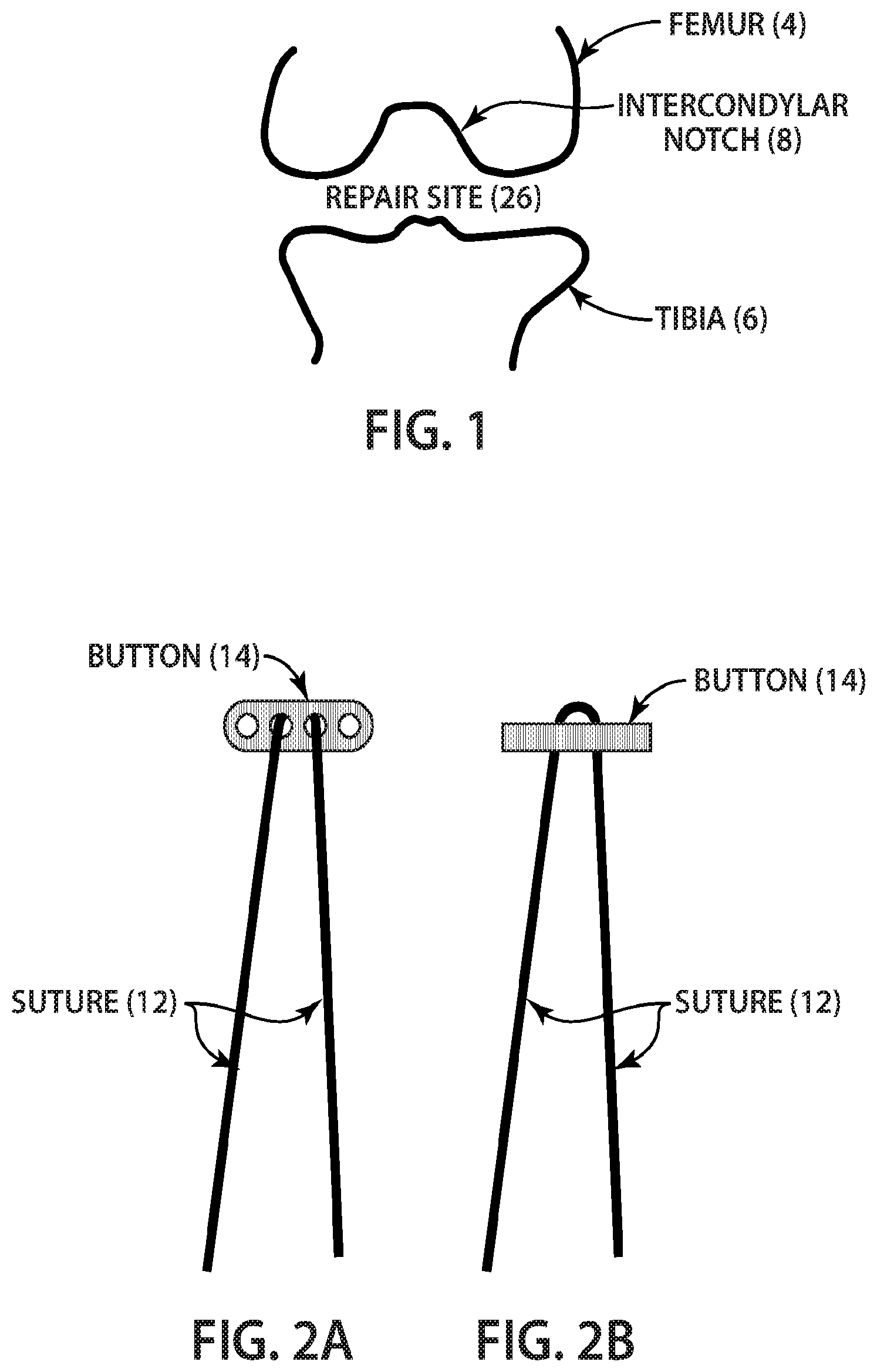 Patent US12377193 Figure 1 – Indirect method of articular tissue repair
