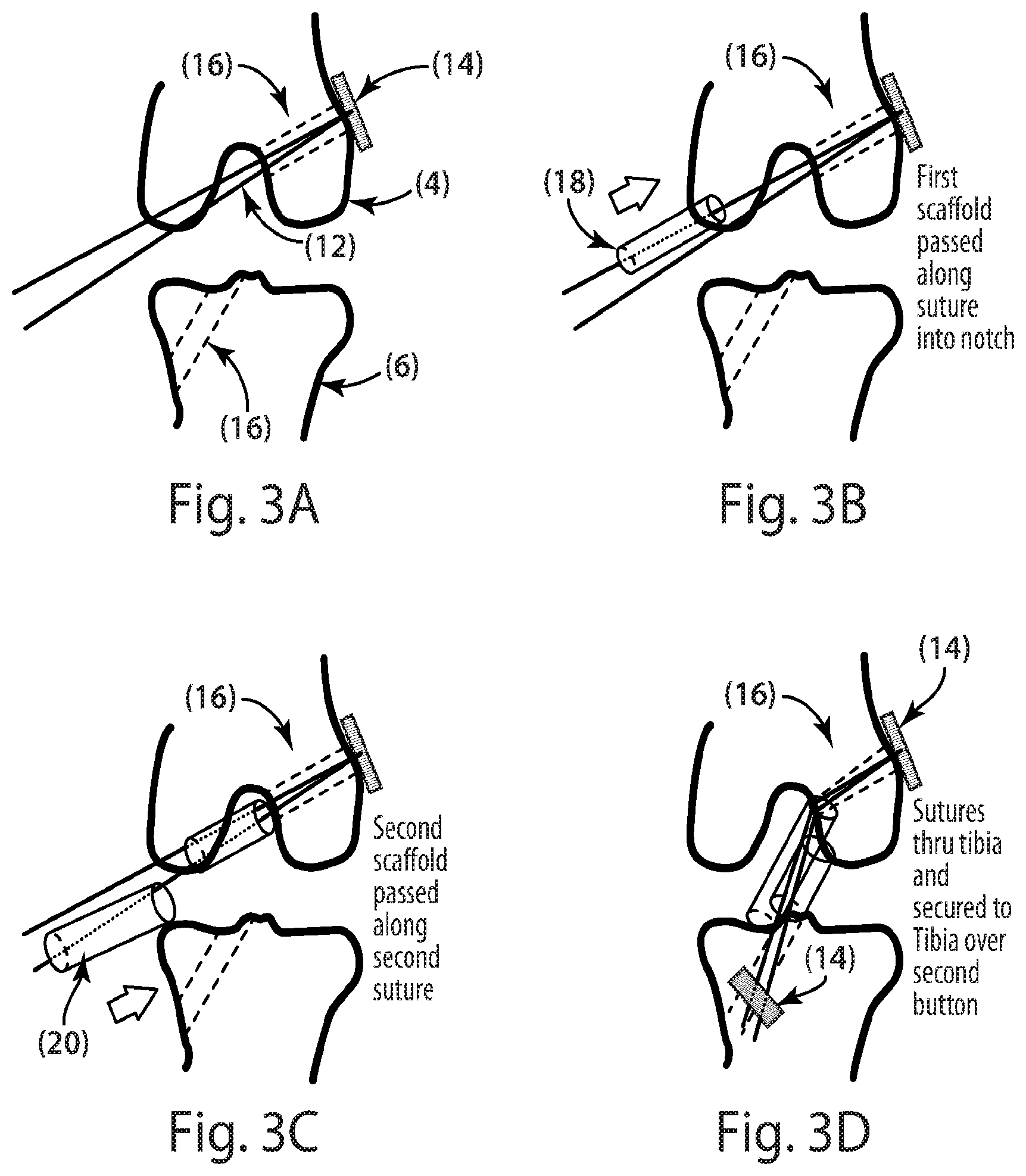 Patent US12377193 Figure 2 – Indirect method of articular tissue repair
