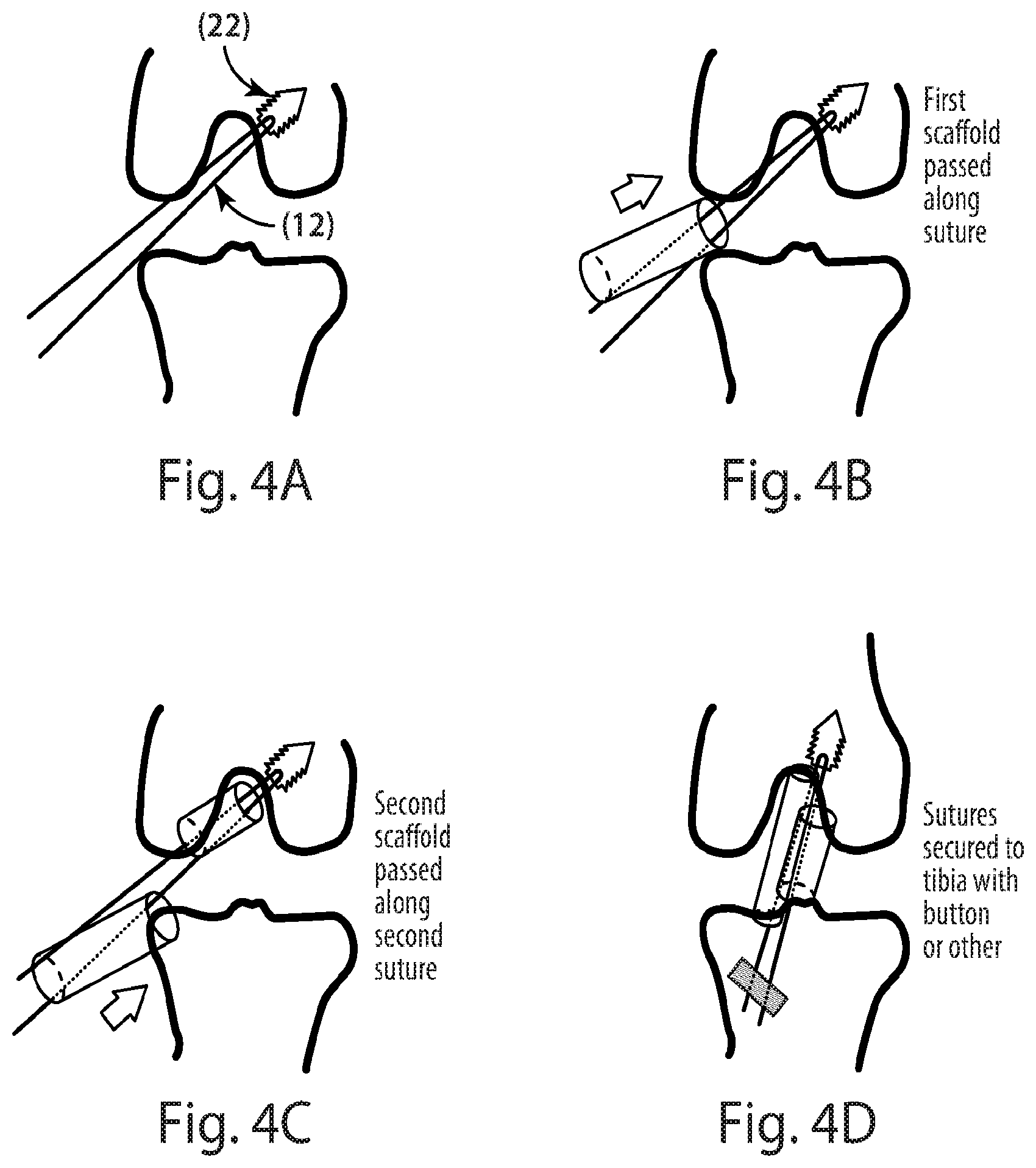 Patent US12377193 Figure 3 – Indirect method of articular tissue repair