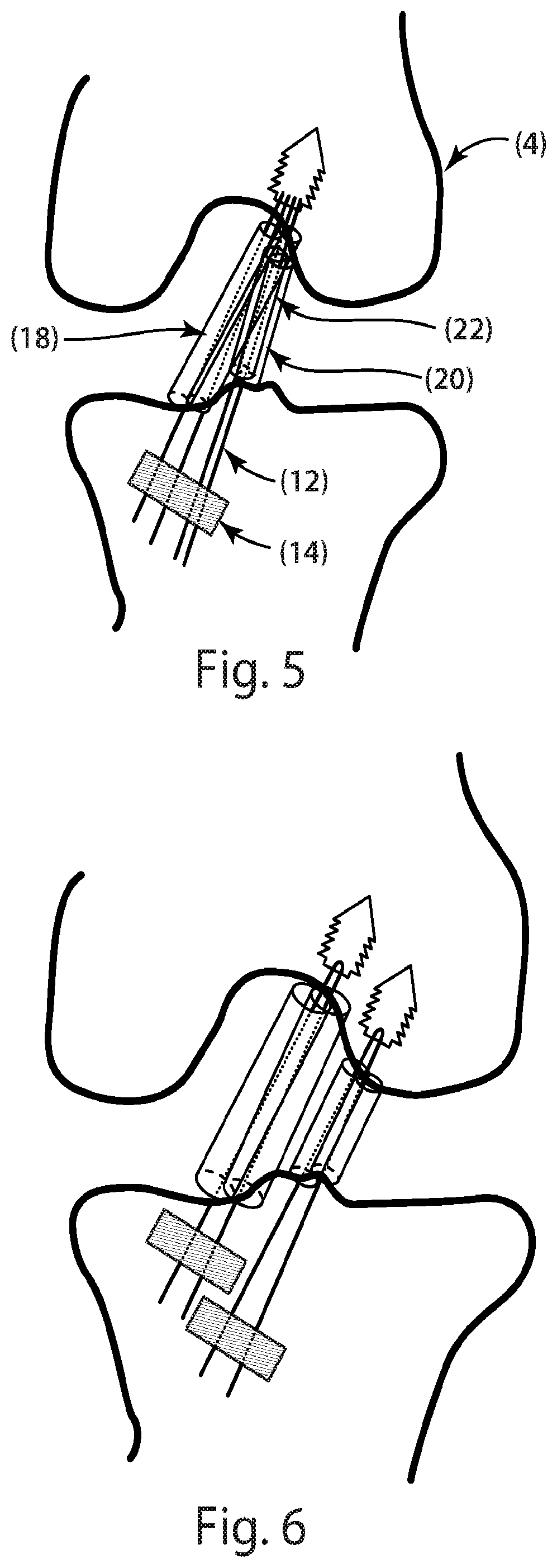 Patent US12377193 Figure 4 – Indirect method of articular tissue repair