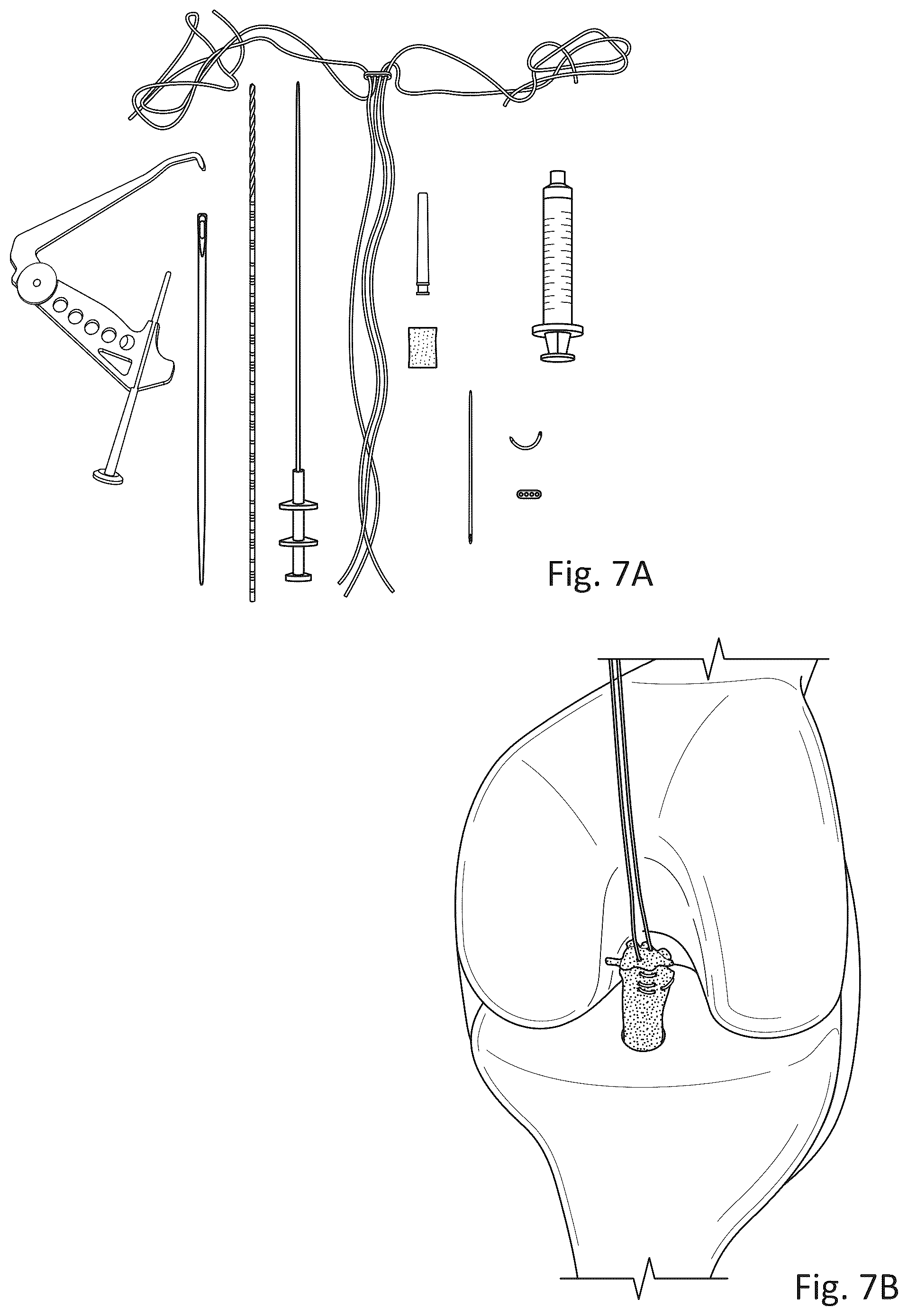 Patent US12377193 Figure 5 – Indirect method of articular tissue repair