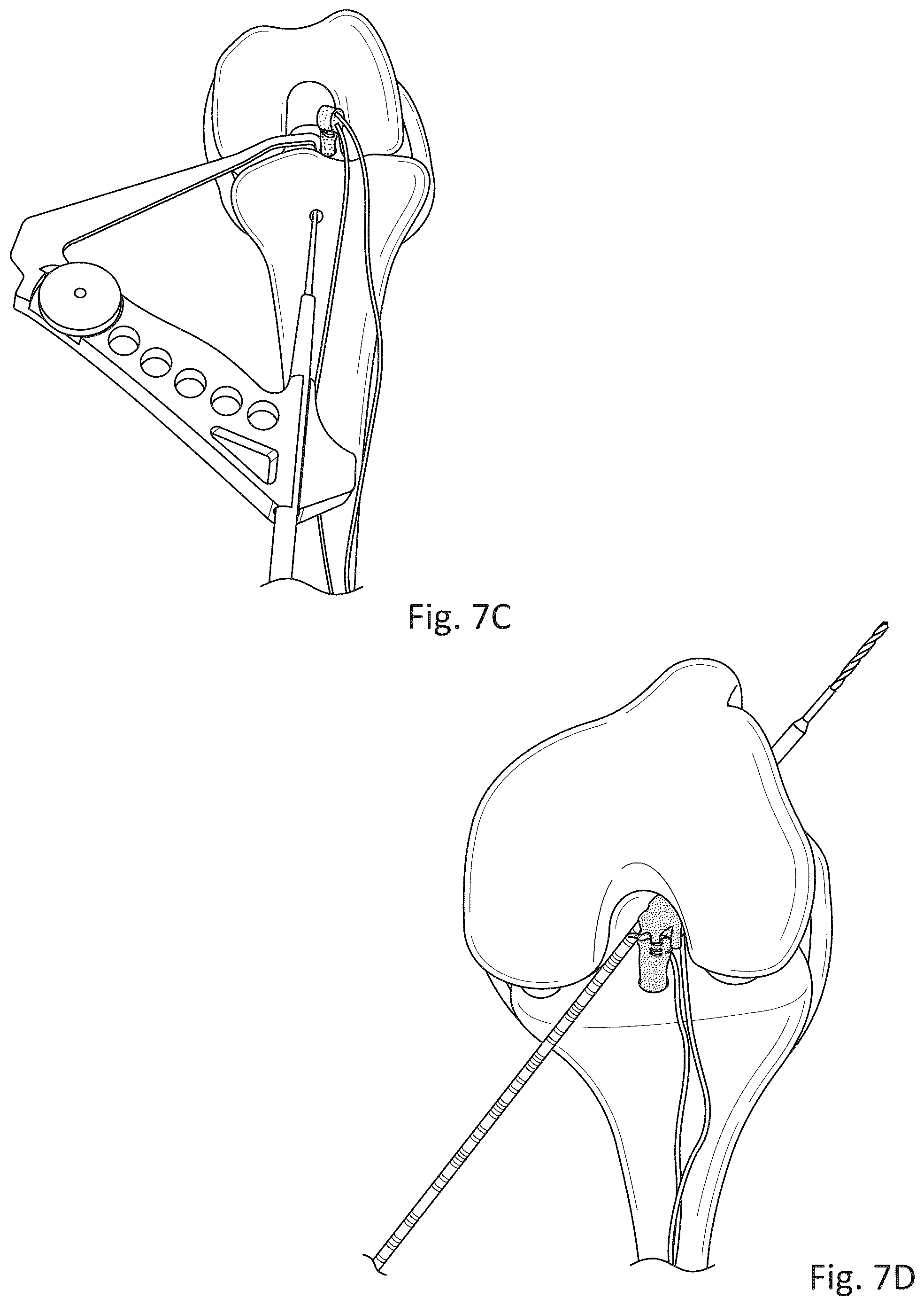 Patent US12377193 Figure 6 – Indirect method of articular tissue repair