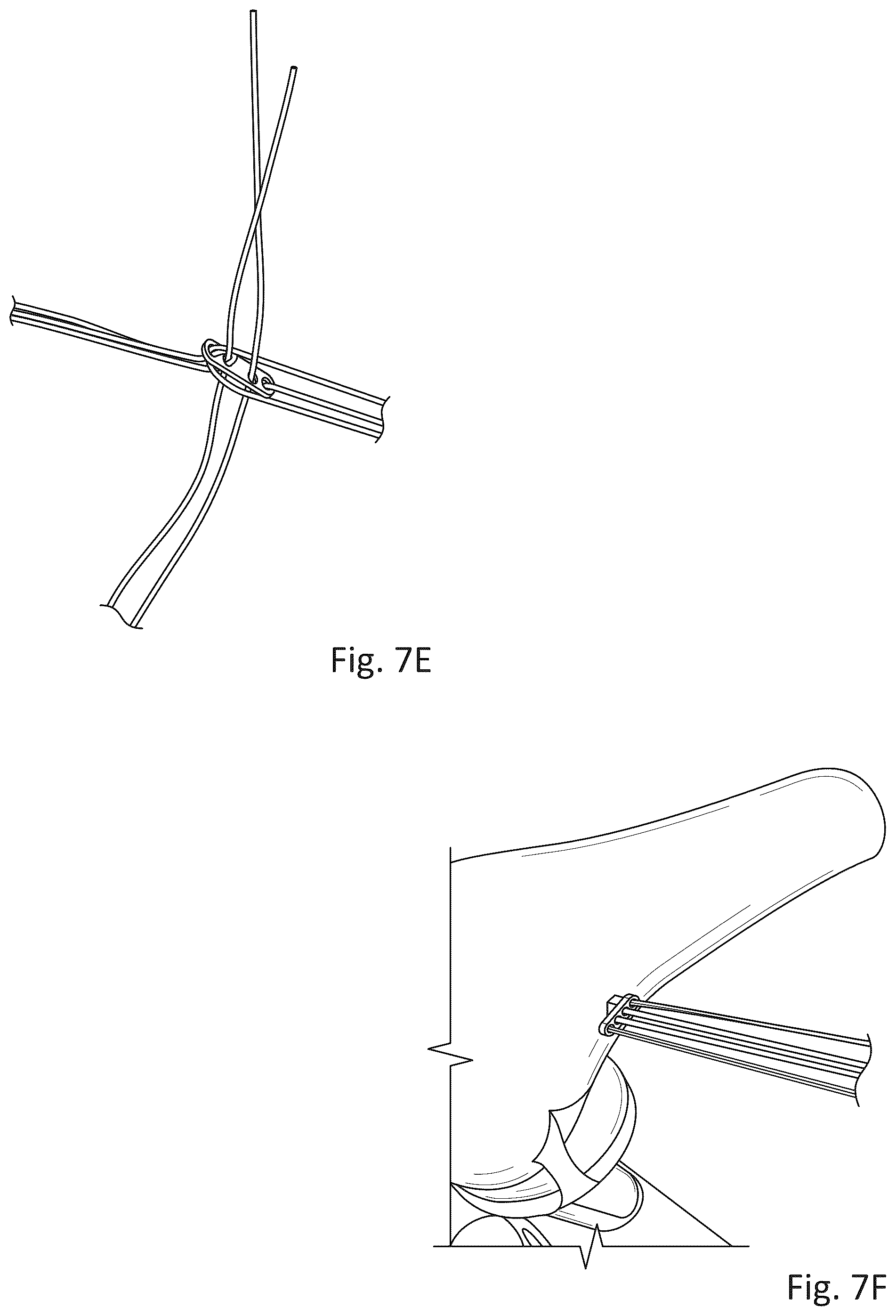 Patent US12377193 Figure 7 – Indirect method of articular tissue repair