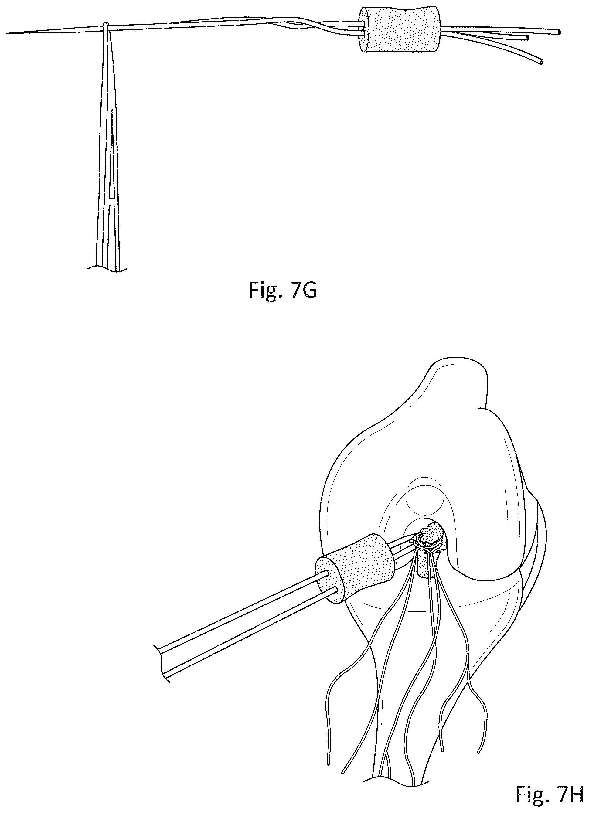 Patent US12377193 Figure 8 – Indirect method of articular tissue repair