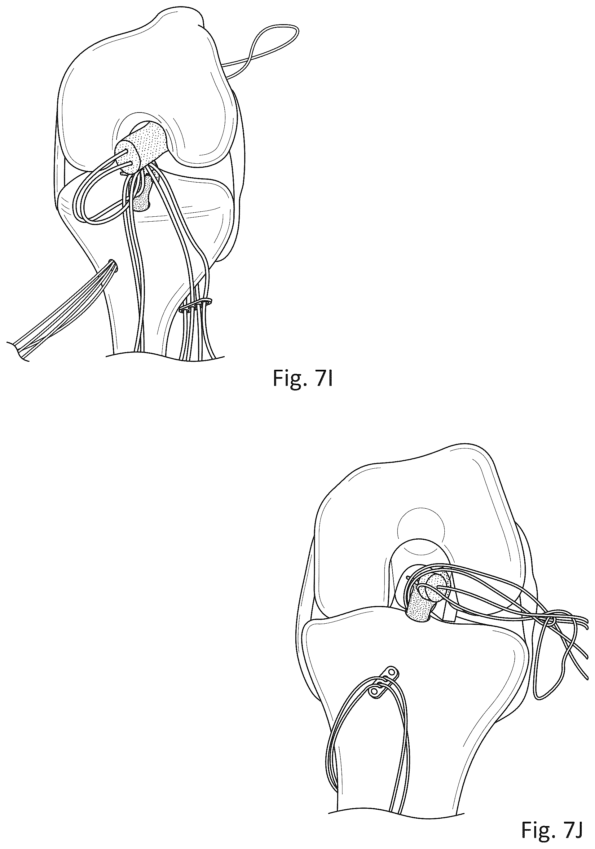 Patent US12377193 Figure 9 – Indirect method of articular tissue repair