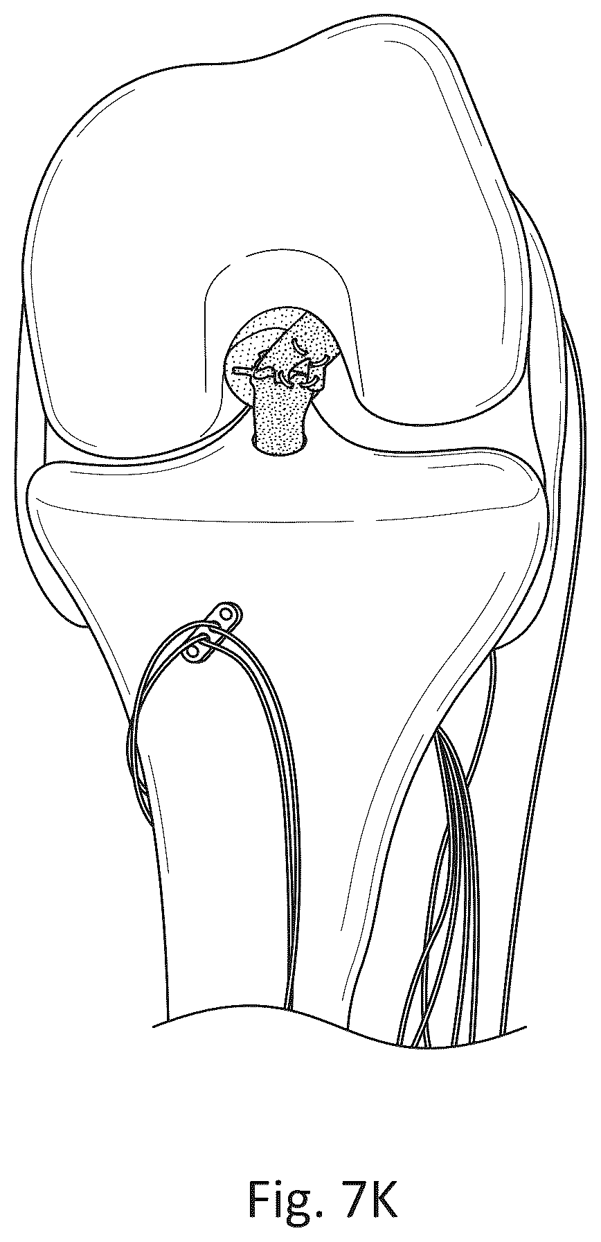 Patent US12377193 Figure 10 – Indirect method of articular tissue repair