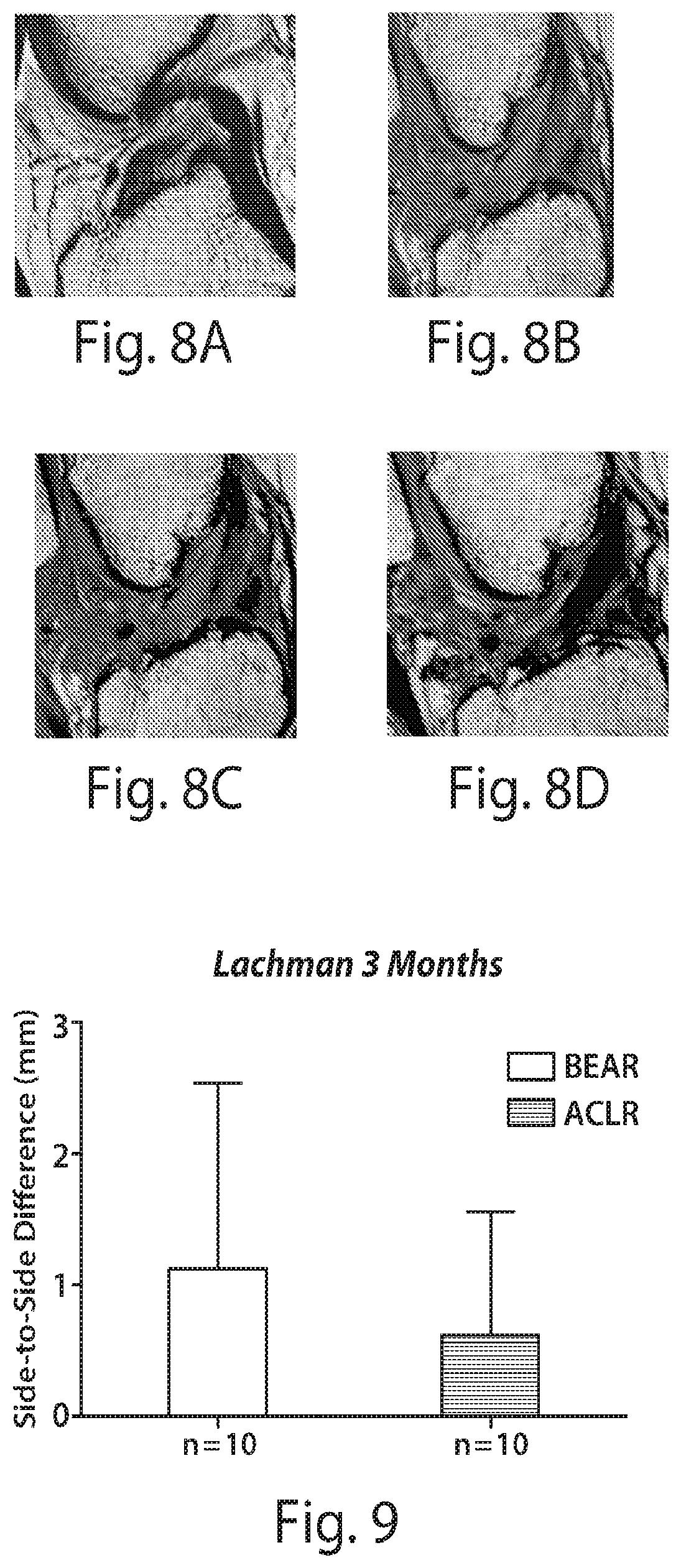 Patent US12377193 Figure 11 – Indirect method of articular tissue repair