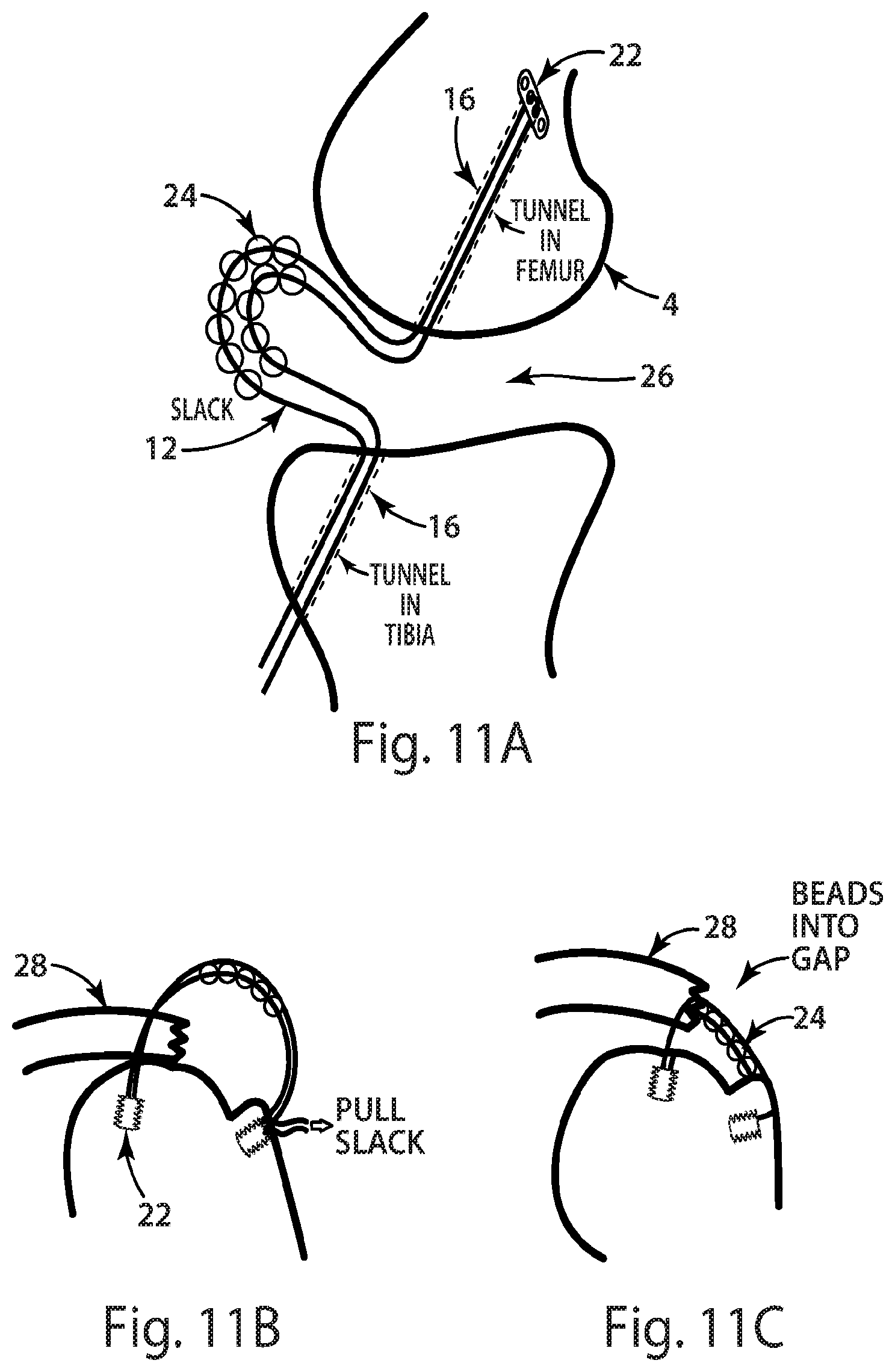 Patent US12377193 Figure 13 – Indirect method of articular tissue repair