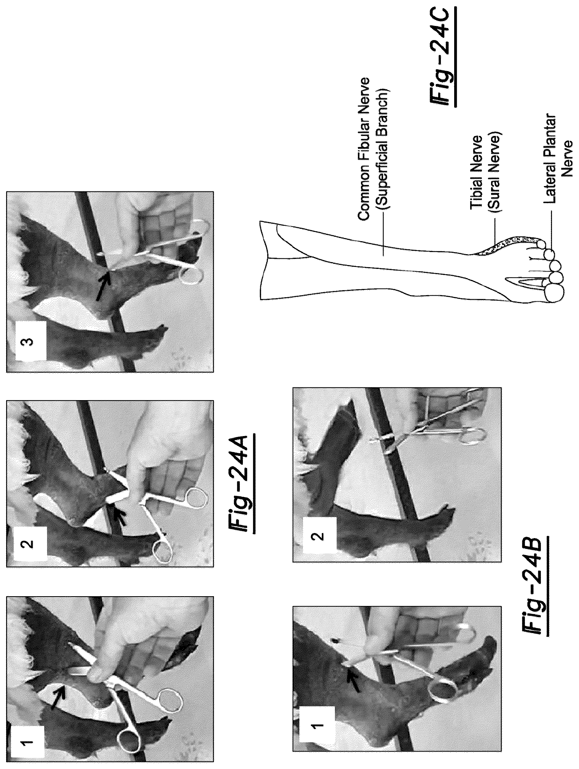 Patent US12377195 Figure 17 – Nerve repair scaffolds having high microchannel volume and methods for making the same
