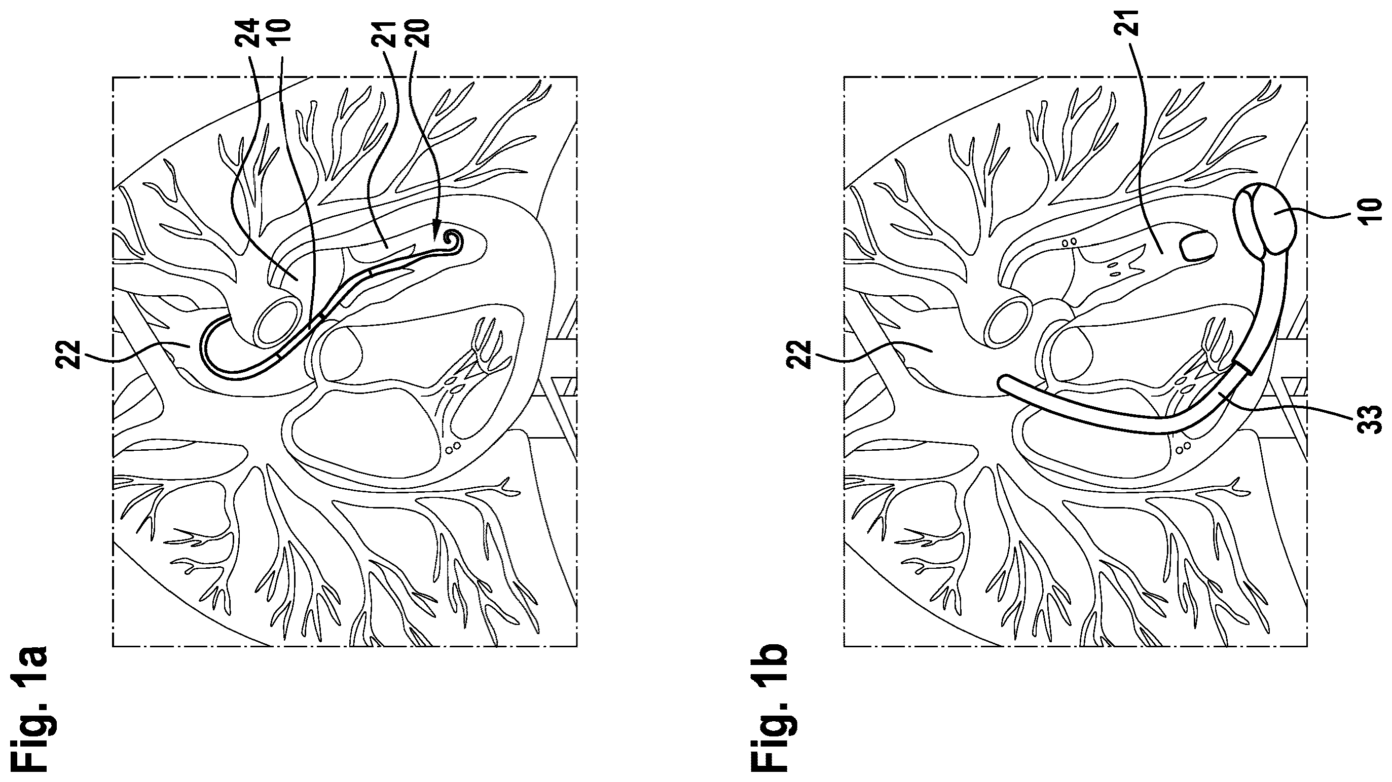 Patent US12377256 Figure 1 – Cardiac support system flow measurement using pressure sensors