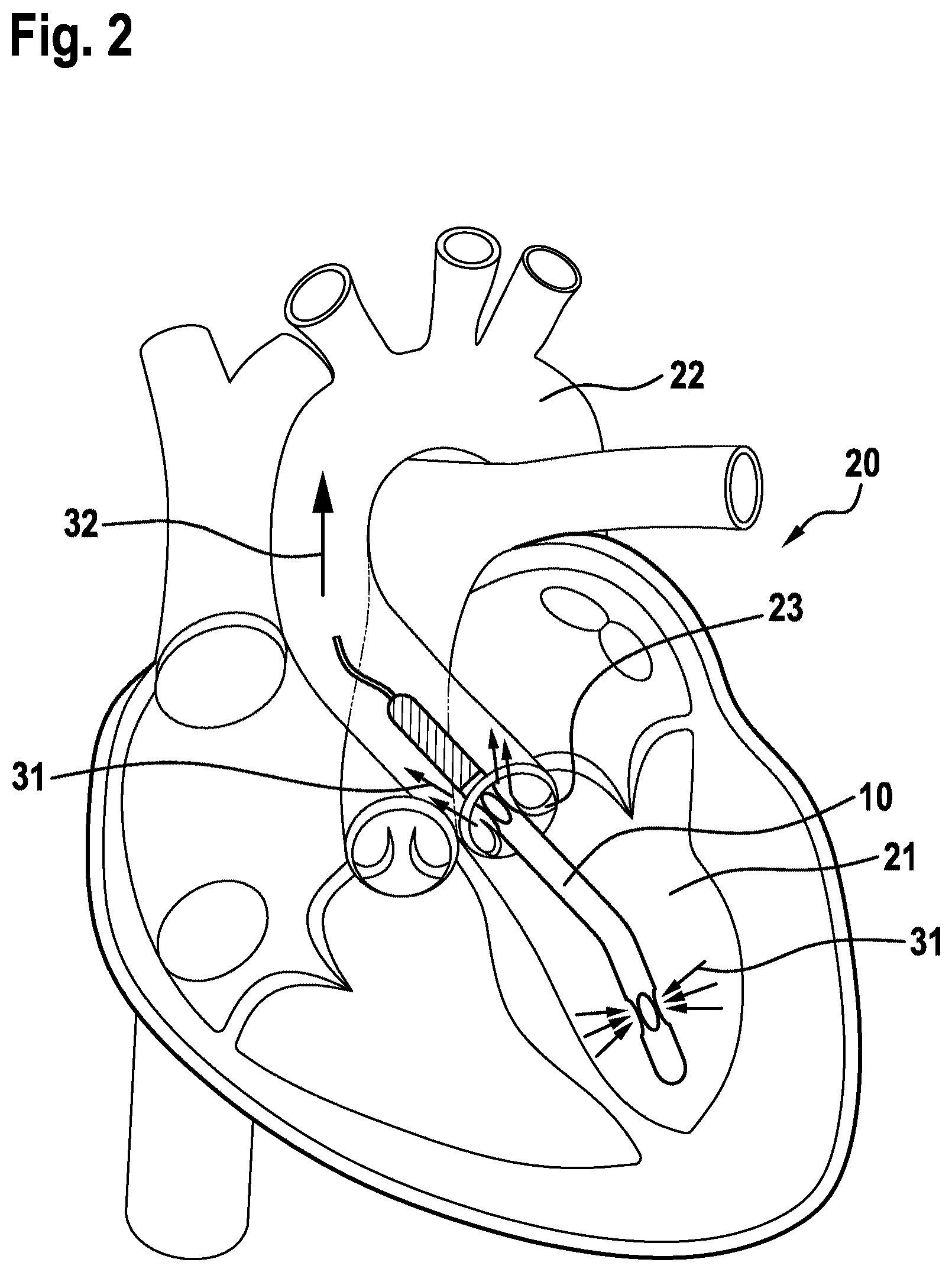 Patent US12377256 Figure 2 – Cardiac support system flow measurement using pressure sensors