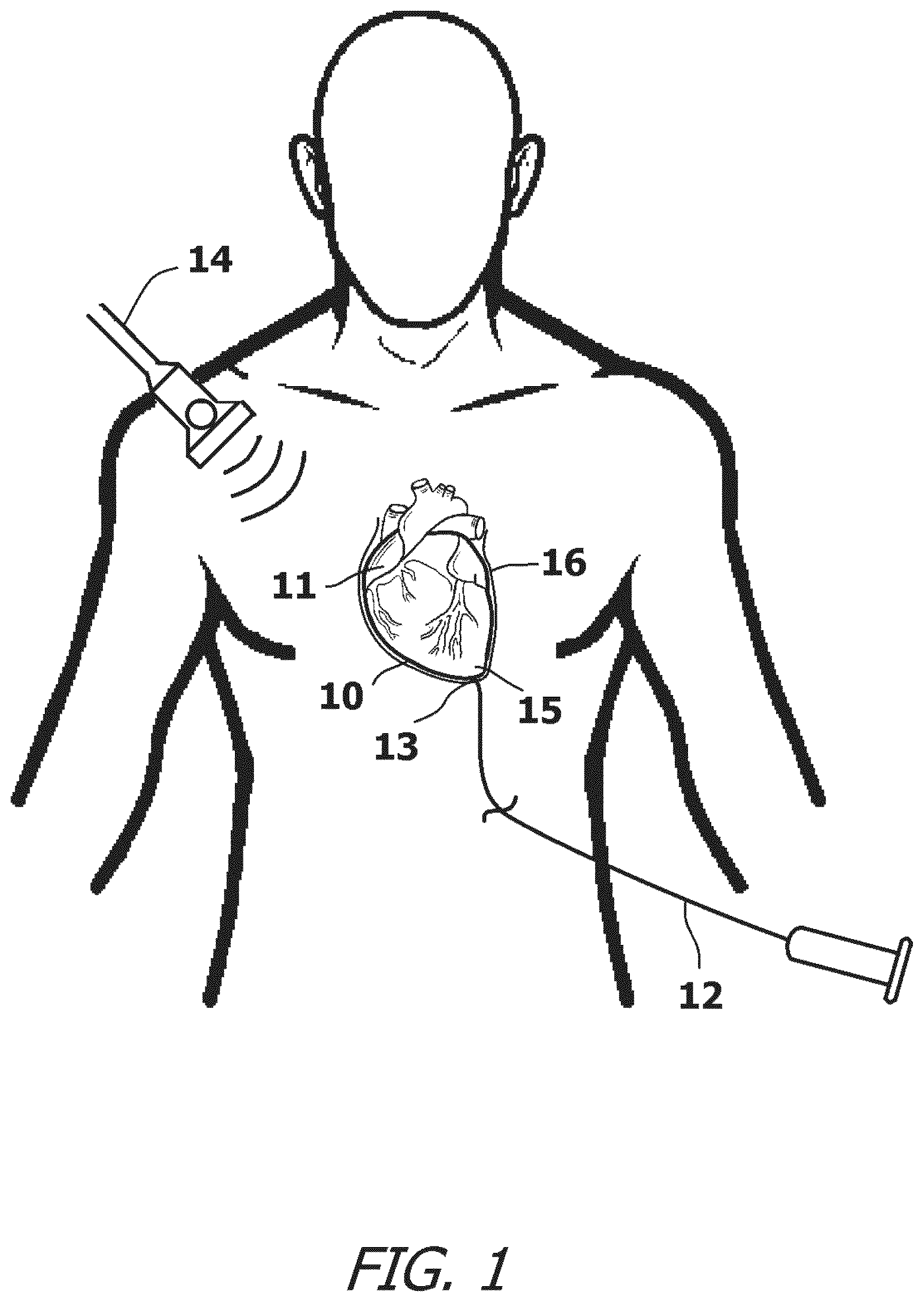 Patent US12377259 Figure 1 – System and method for introducing a construct either on or around the surface of the heart