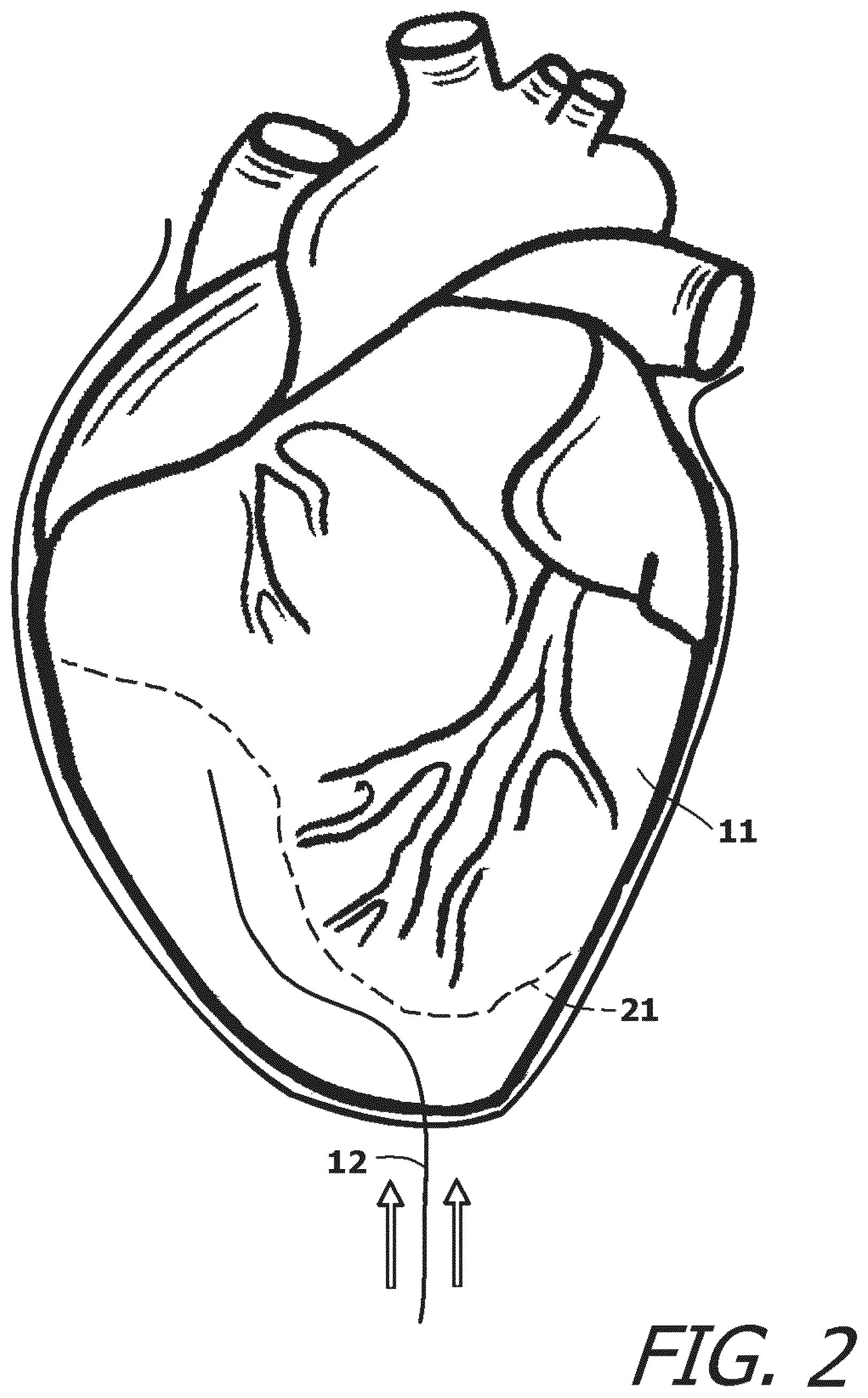 Patent US12377259 Figure 2 – System and method for introducing a construct either on or around the surface of the heart