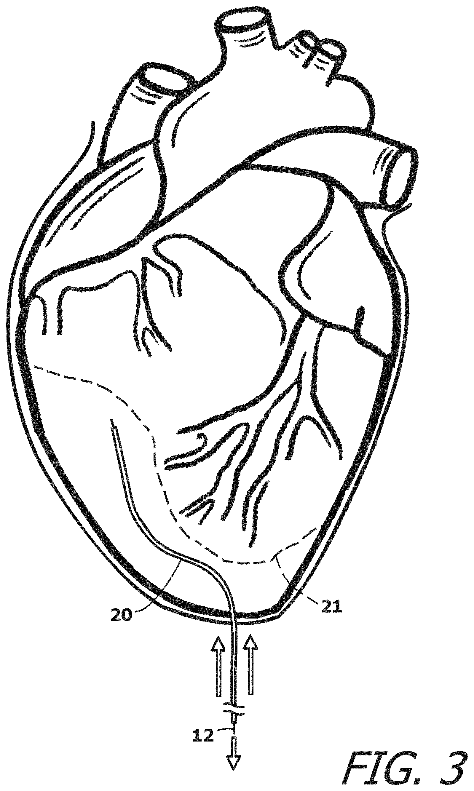 Patent US12377259 Figure 3 – System and method for introducing a construct either on or around the surface of the heart