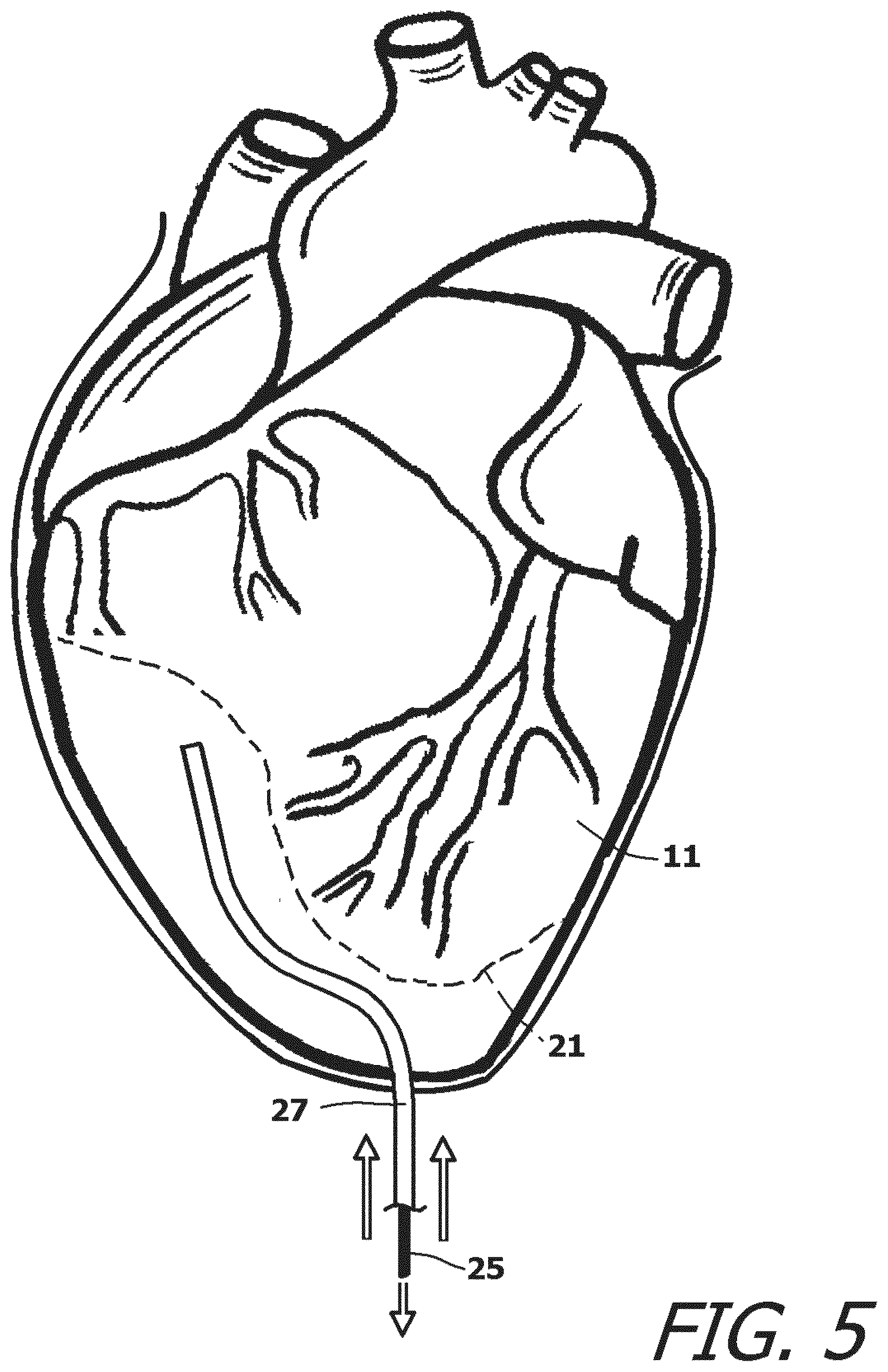 Patent US12377259 Figure 5 – System and method for introducing a construct either on or around the surface of the heart
