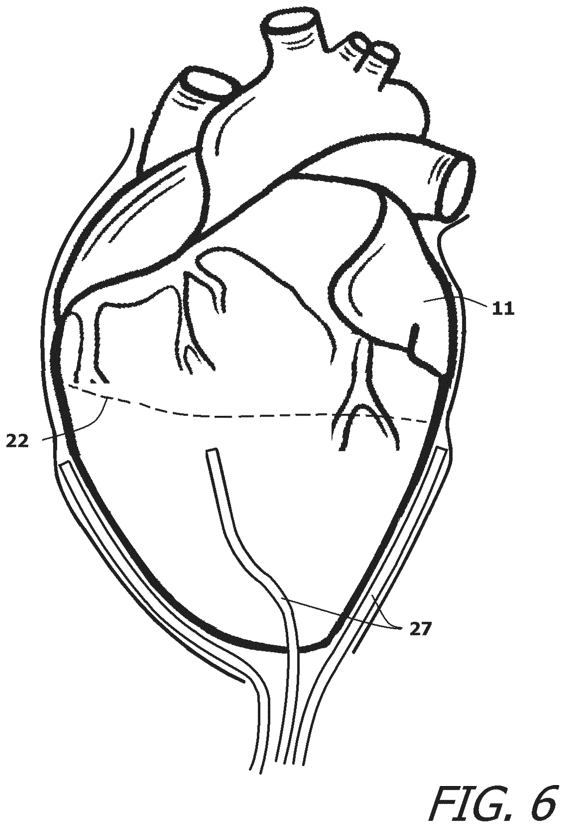 Patent US12377259 Figure 6 – System and method for introducing a construct either on or around the surface of the heart