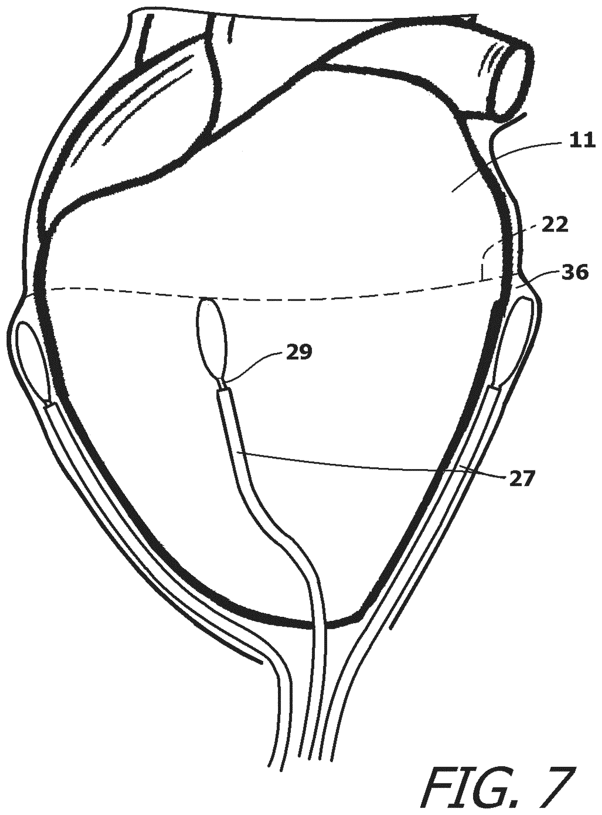 Patent US12377259 Figure 7 – System and method for introducing a construct either on or around the surface of the heart